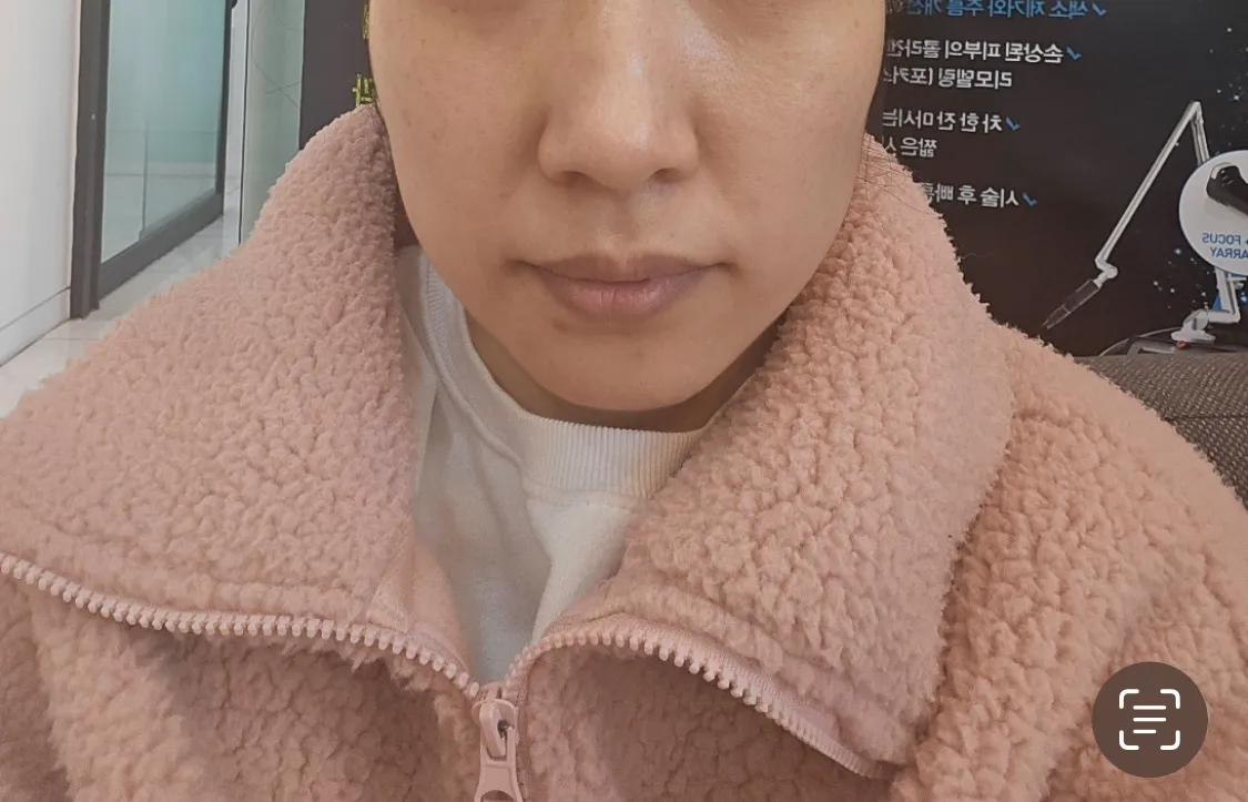 시술 전 — 송도비앤미 틴트입술 반영구