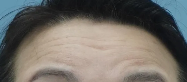 项目前 — 计划者♥内窥镜额头提升