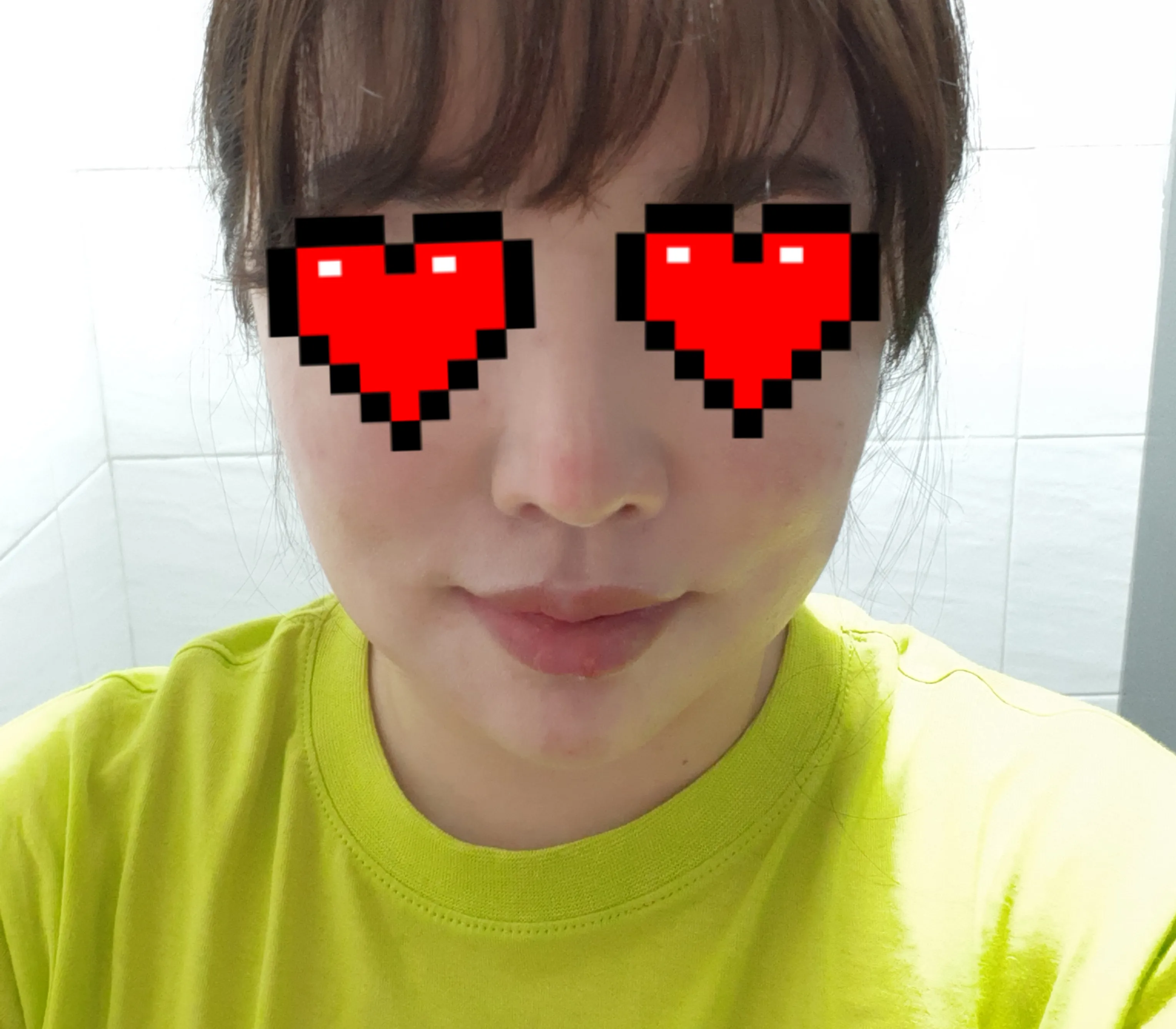 시술 전 — 명품스킨부스터 #NCTF주사 