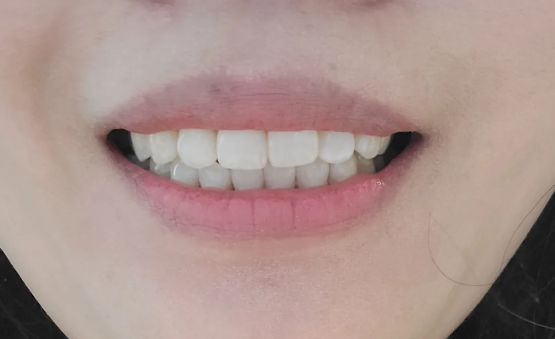 After treatment — 30-Minute Complete Teeth Whitening Program
