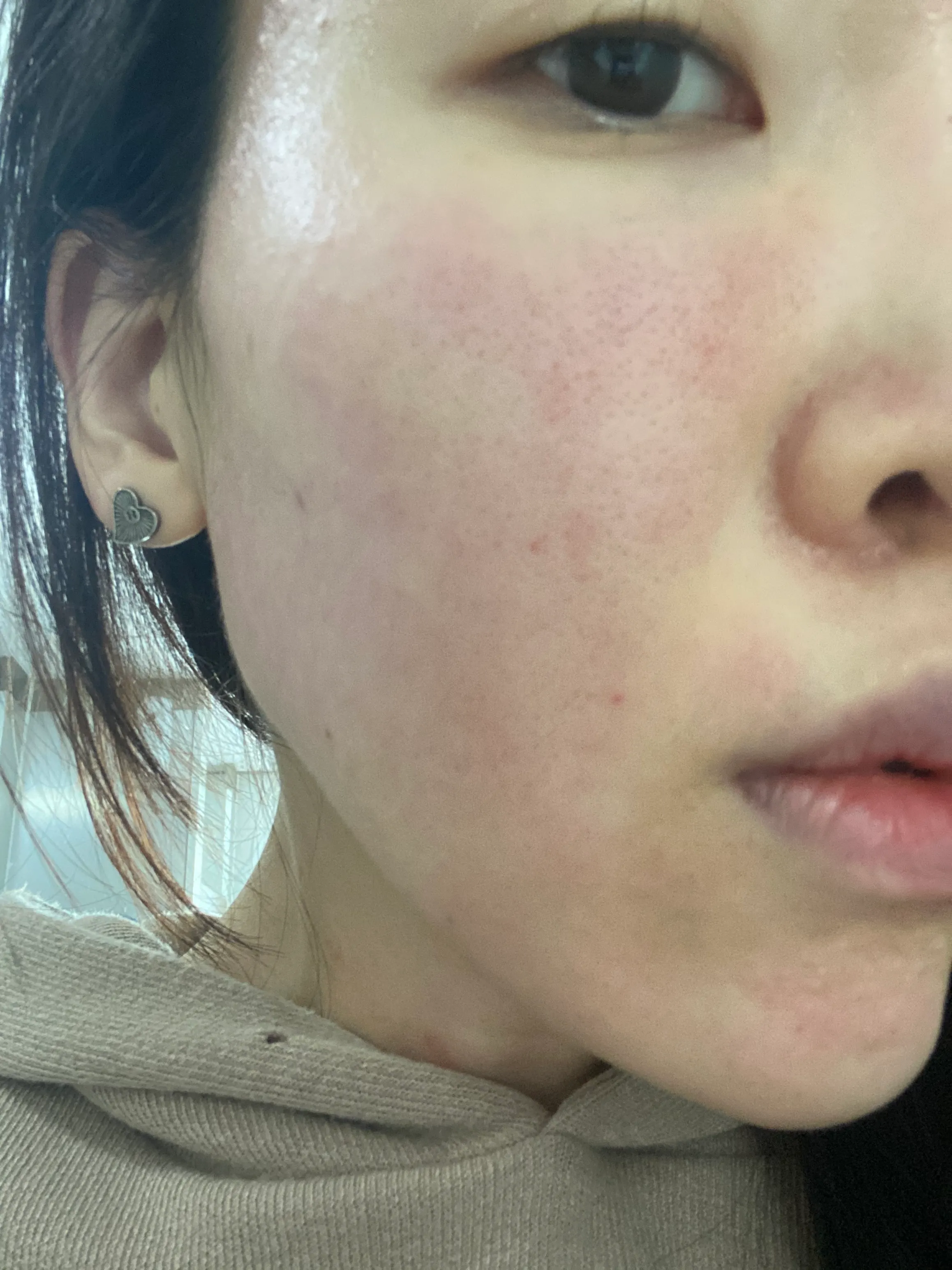 Before treatment — Pain reduction special #Rejuran Healer
