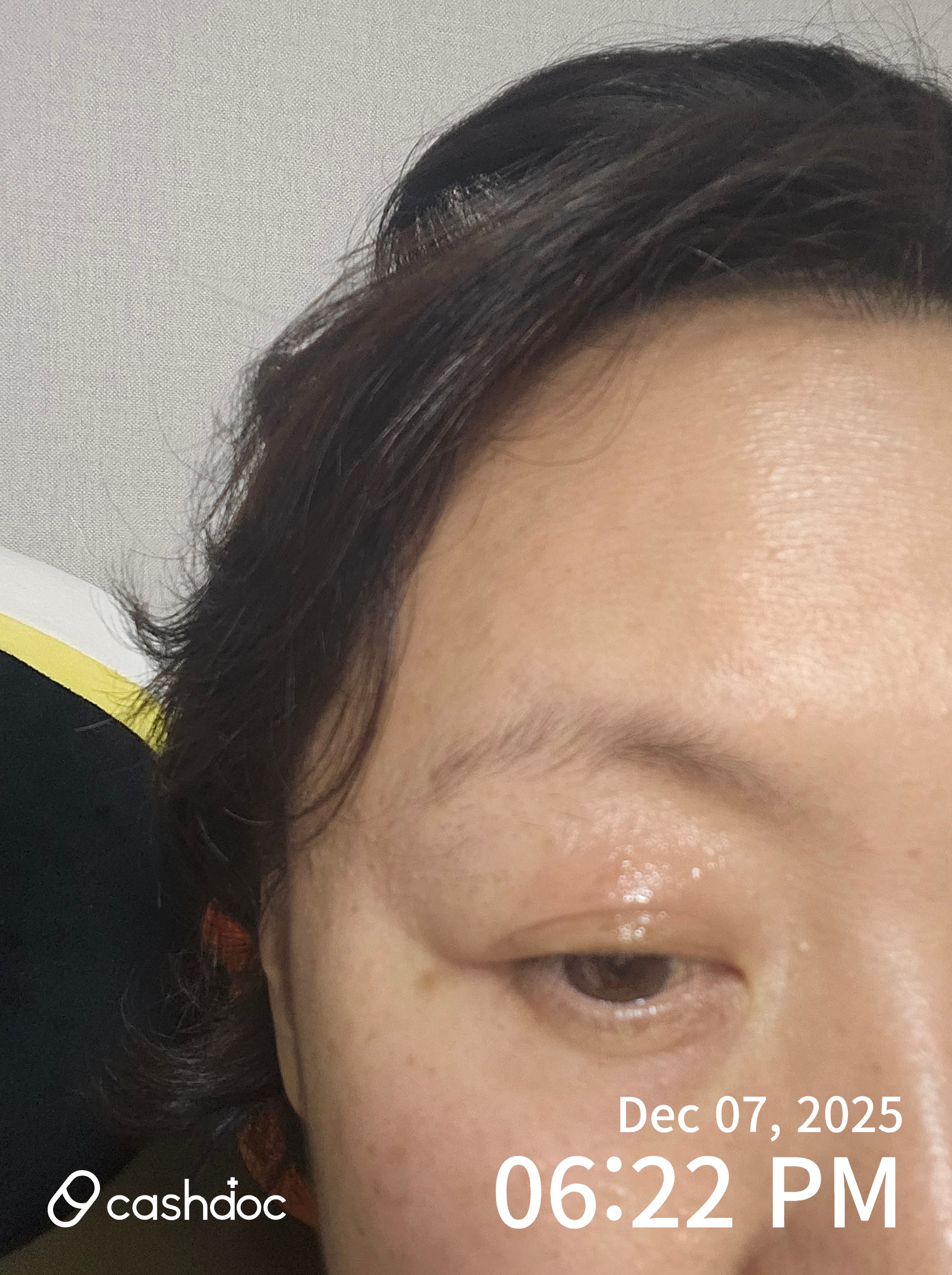 산본 아름다운피부과에서 겪은 눈 부음 긴급 처치 경험