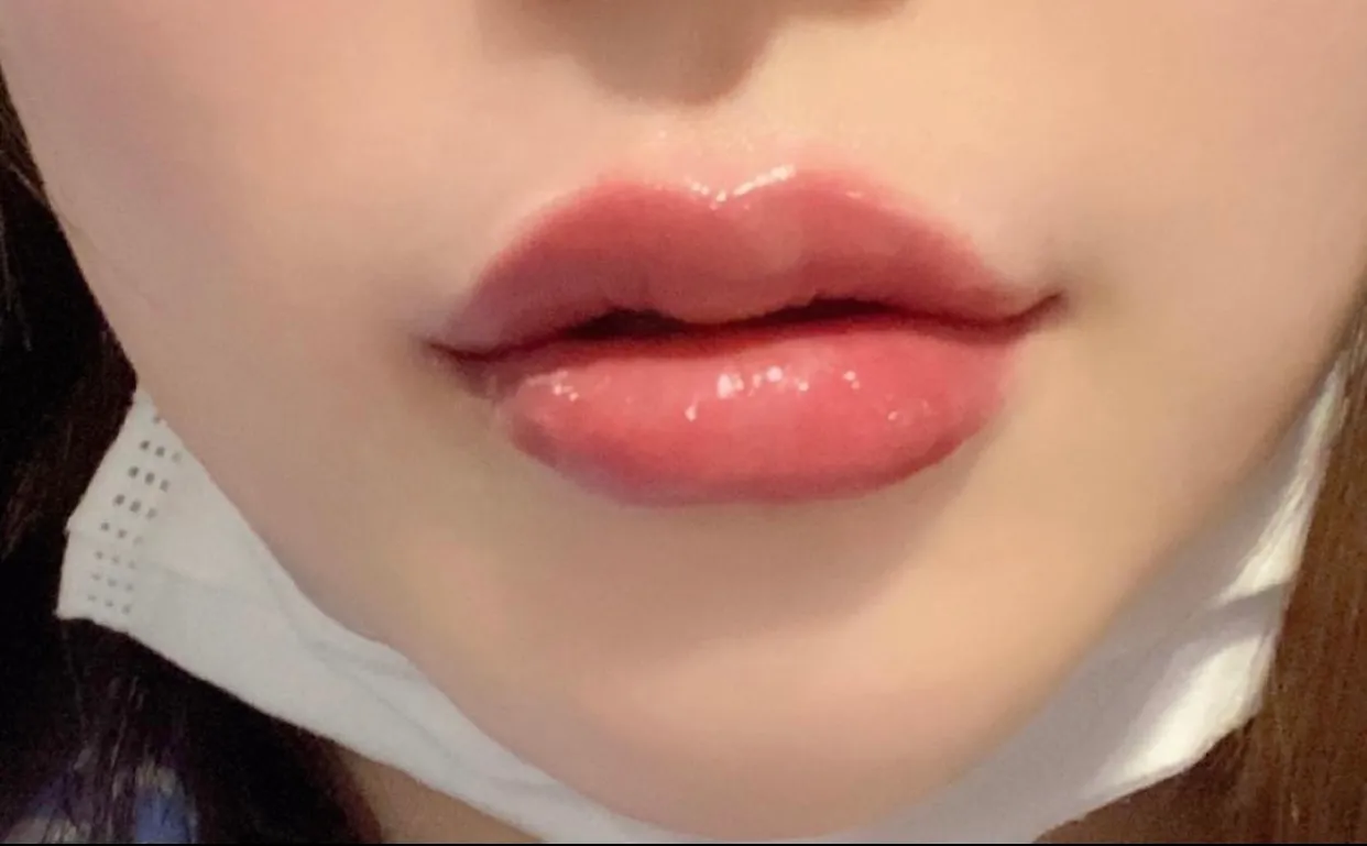 시술 후 — 🧡하뚜입술필러