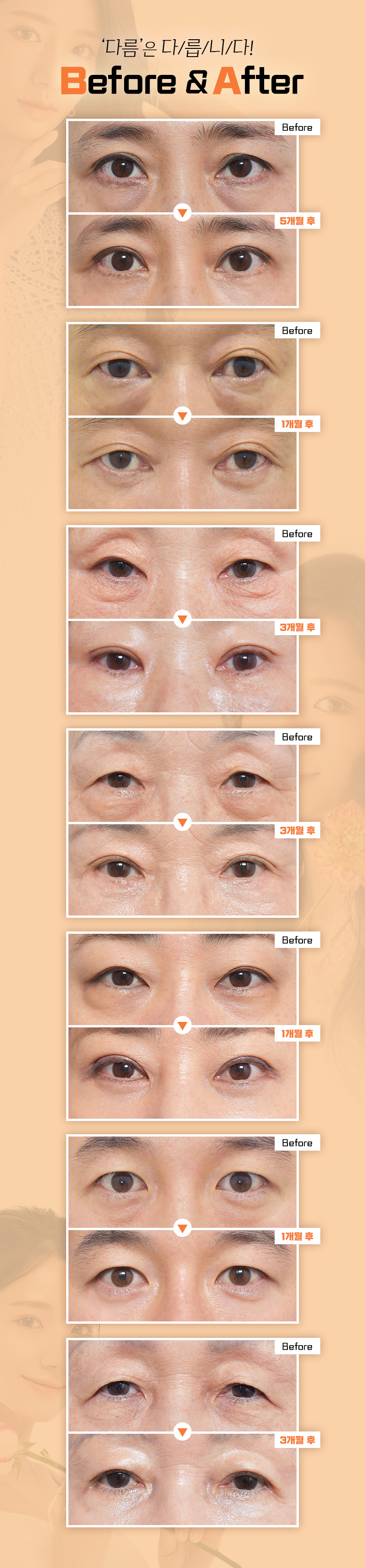 다름성형외과 어두운 눈밑은? 다름 눈밑지방재배치 이벤트, 시술 상세 이미지