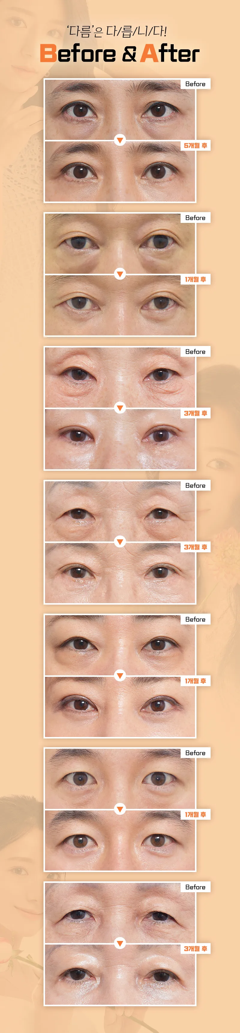 다름성형외과 어두운 눈밑은? 다름 눈밑지방재배치 이벤트, 시술 상세 이미지