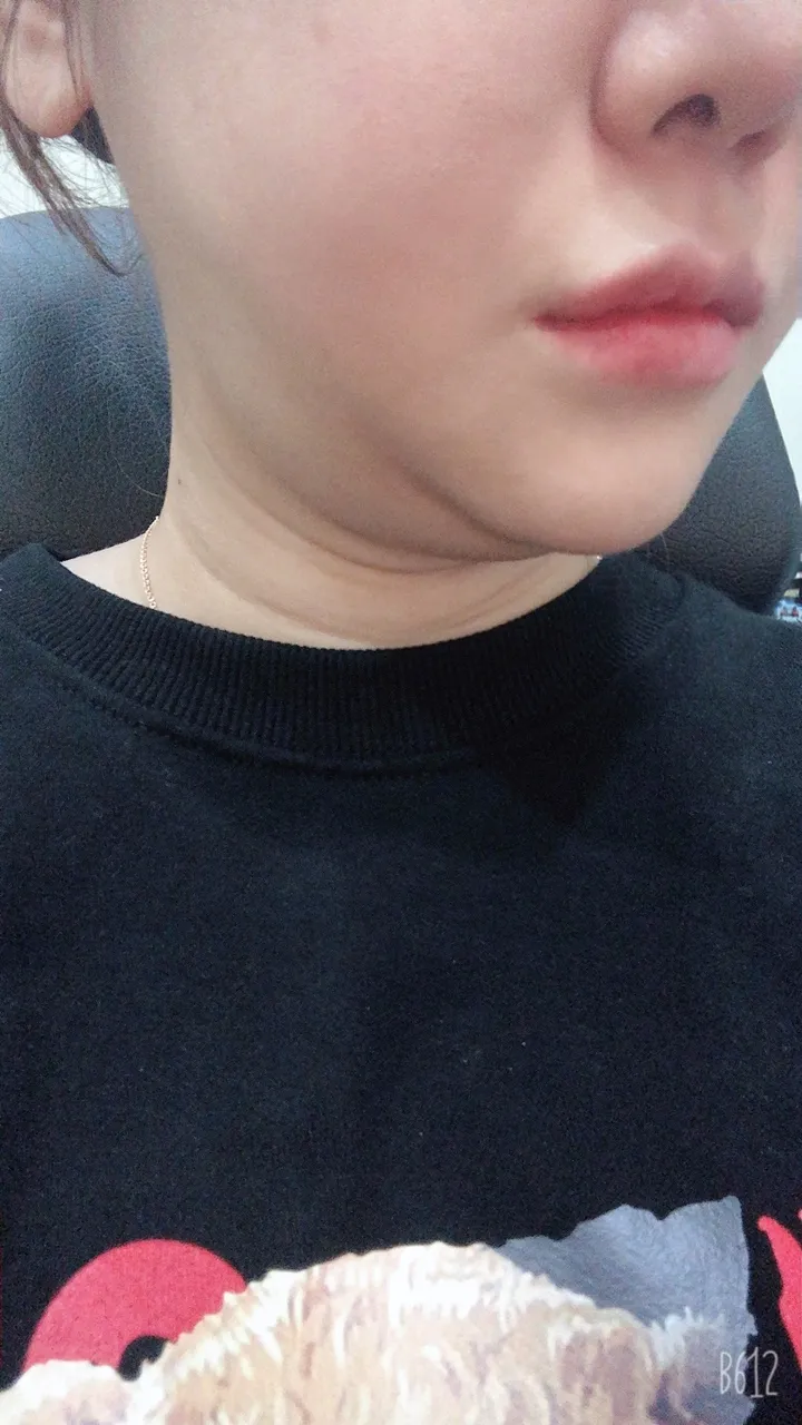 시술 전 — ★밴딩주사★ 이중턱제거