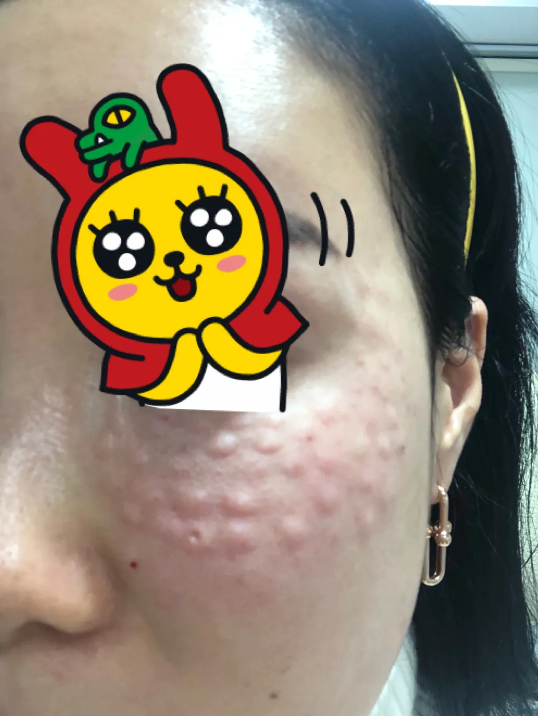 After treatment — Pain-Reducing Special Offer #Rejuran Healer