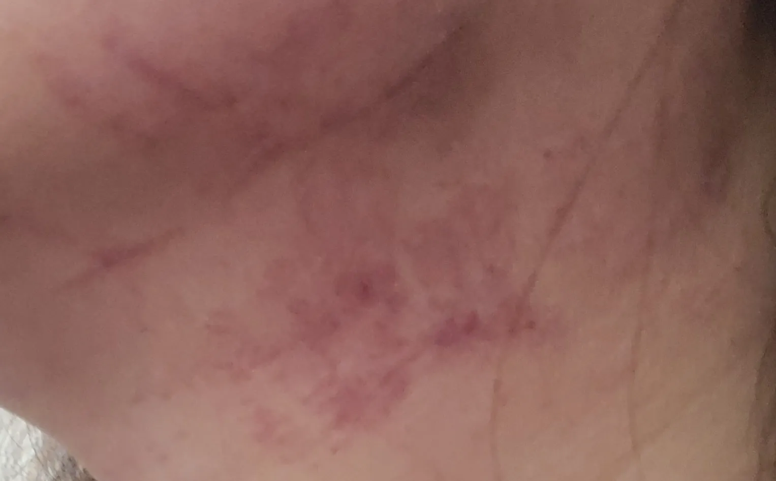 Before treatment — Suwon) Wrinkle & Jawline Botox