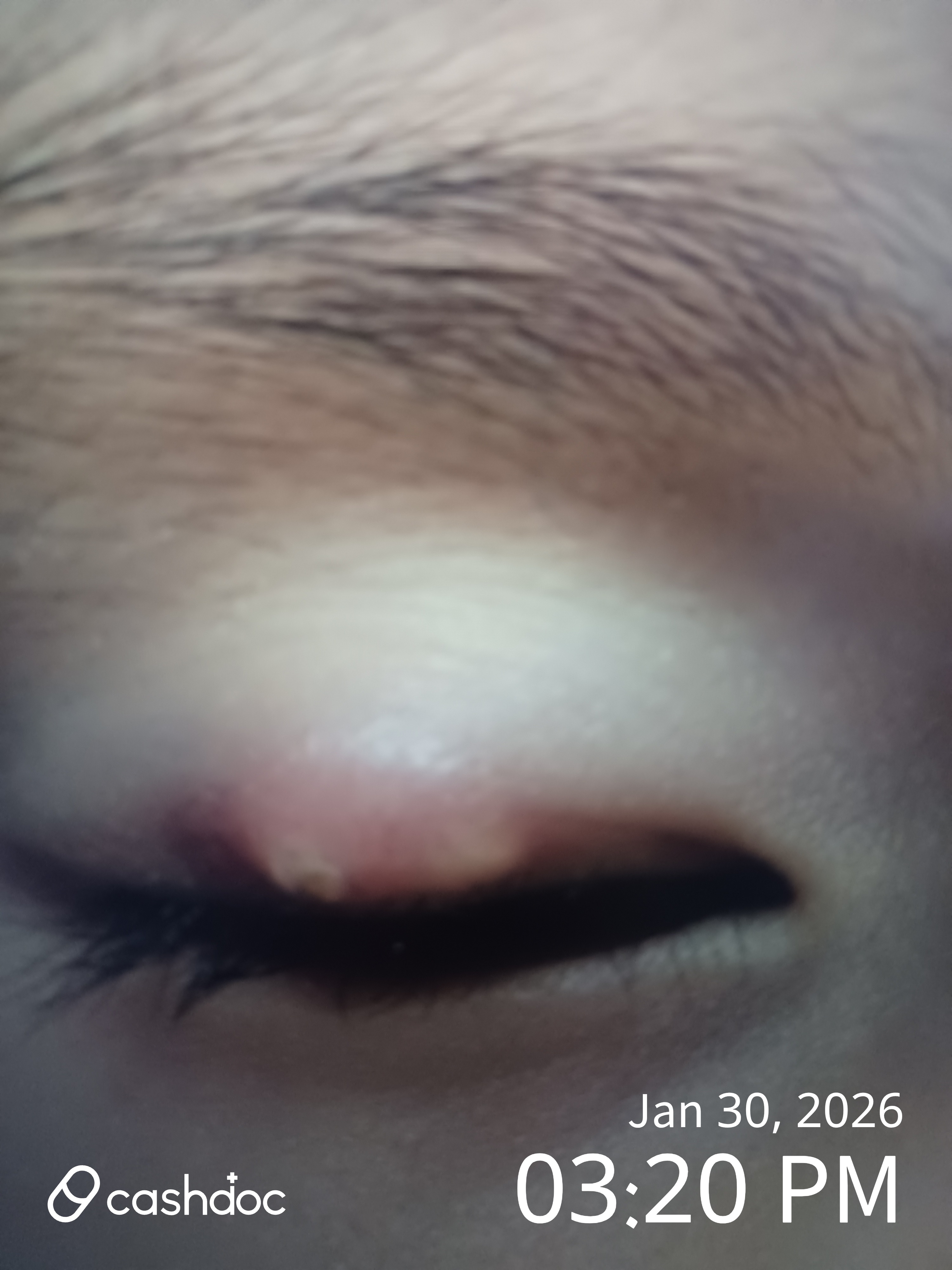 의정부시 신세계안과의원, 다른 병원과는 다른 다래끼 진단