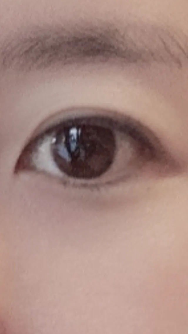After treatment — Lize Eye (Rejuran Eye + Eye Shrink) Package