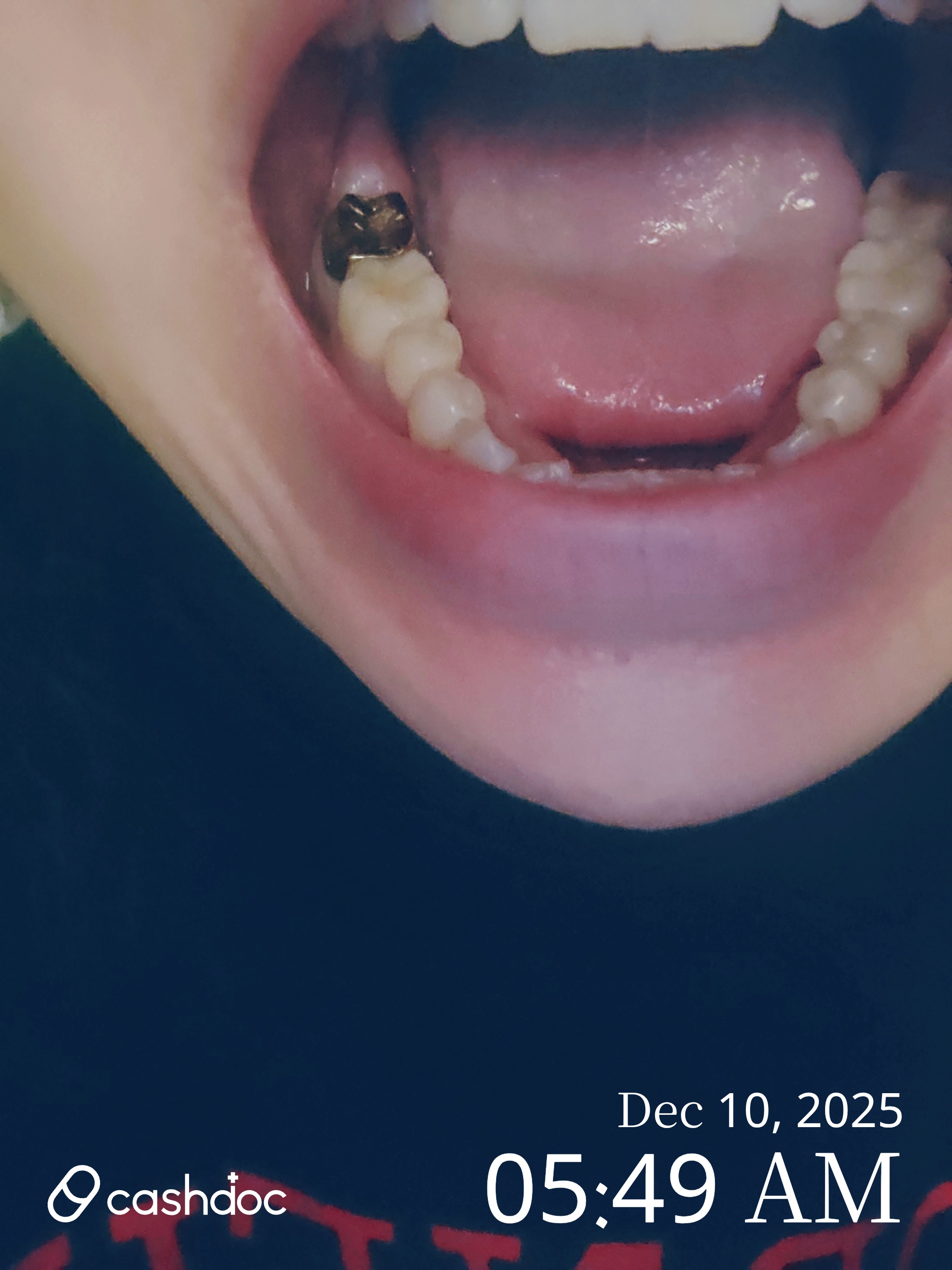 미소가있는치과의원, 크라운 치료 경험이 만족스러워요