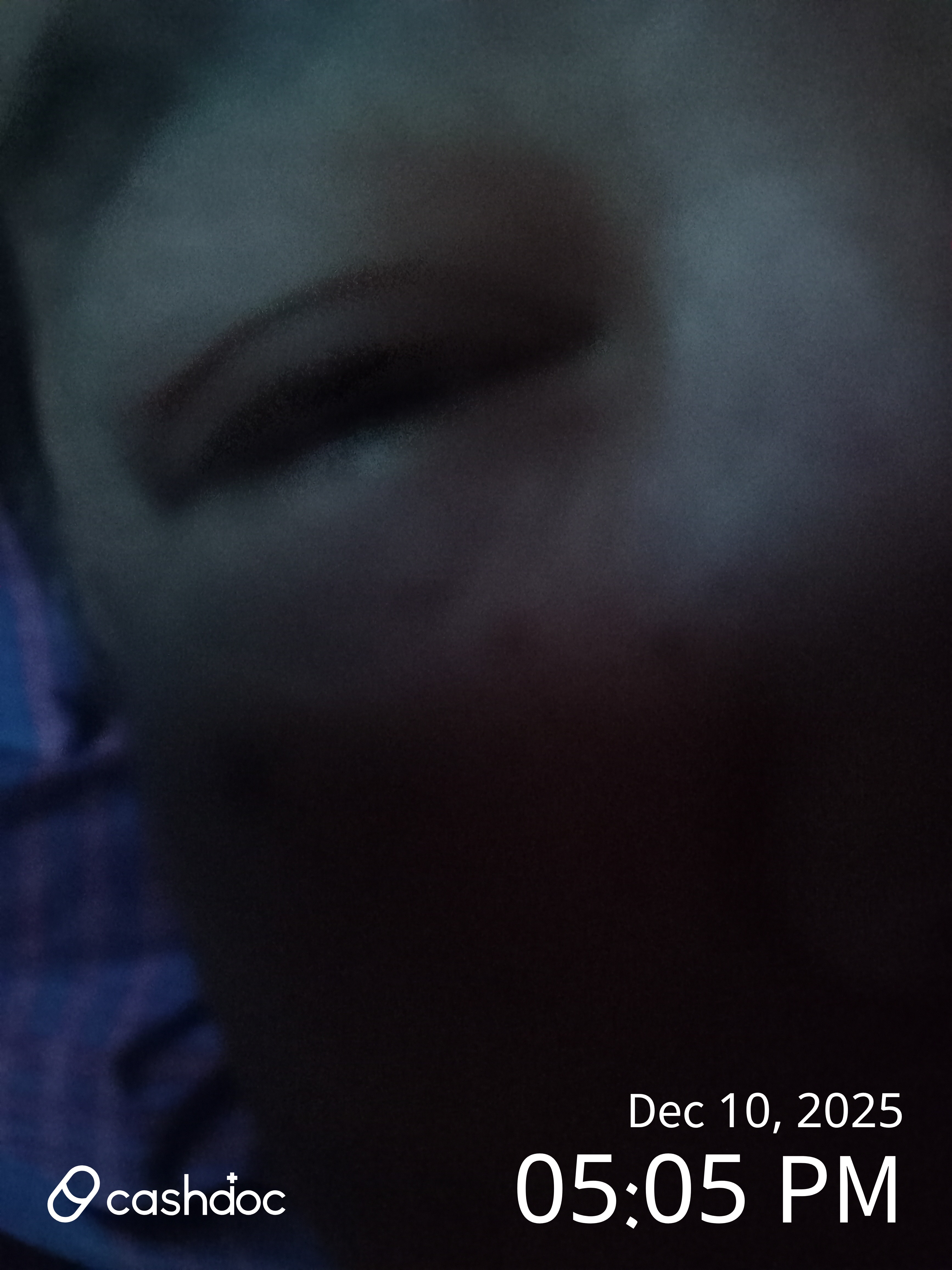 태백시 태백밝은안과의원에서 백내장 수술 후기, 친절하고 회복 빨라요