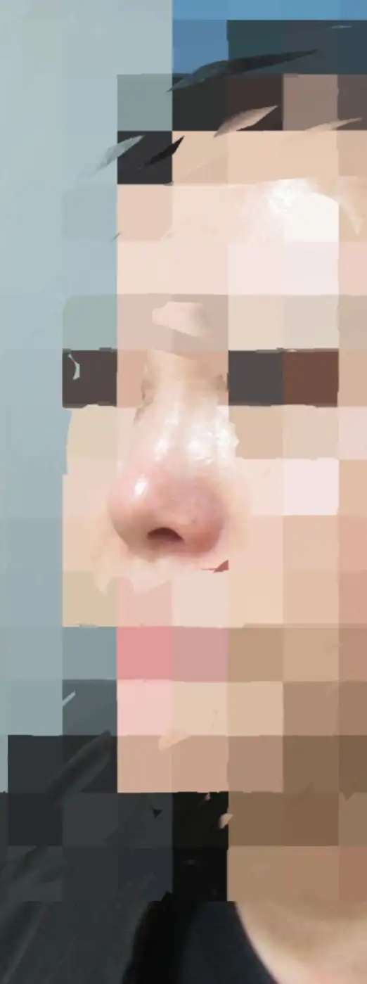 시술 전 — 콧대 콧등 하이코&코필러, 남자포함