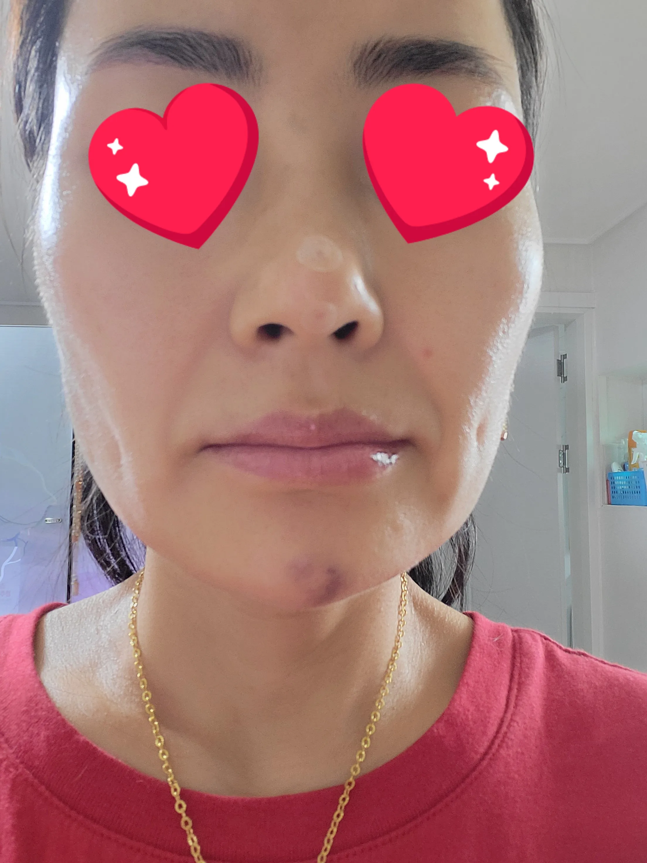 施術後 — ミケイ 自信のある鼻筋 ミント糸_ハイコ