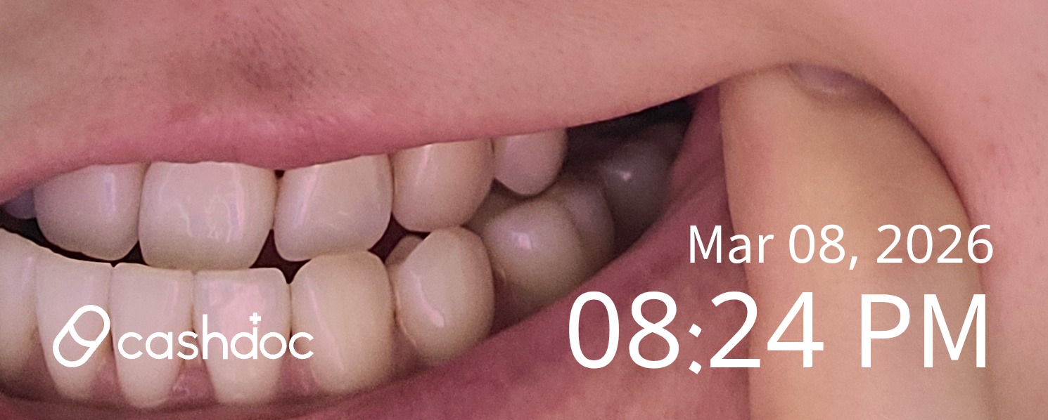 광진구 서울하이안치과의원, 임플란트 치료 후기