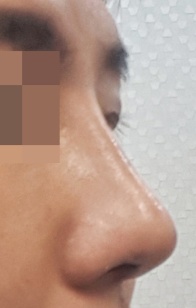 施術後 — 男性のための機能的鼻形成