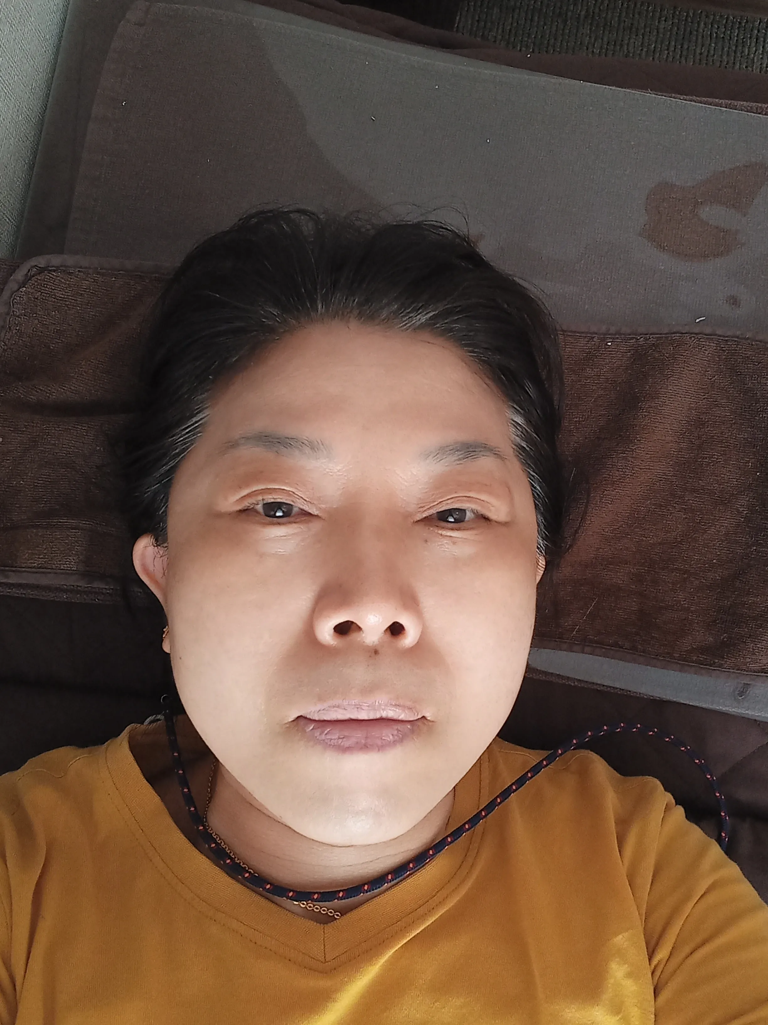 시술 전 — 디오레 아기레이저