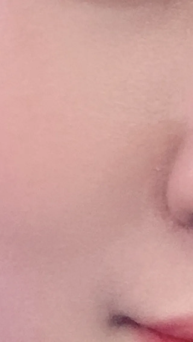 시술 후 사진