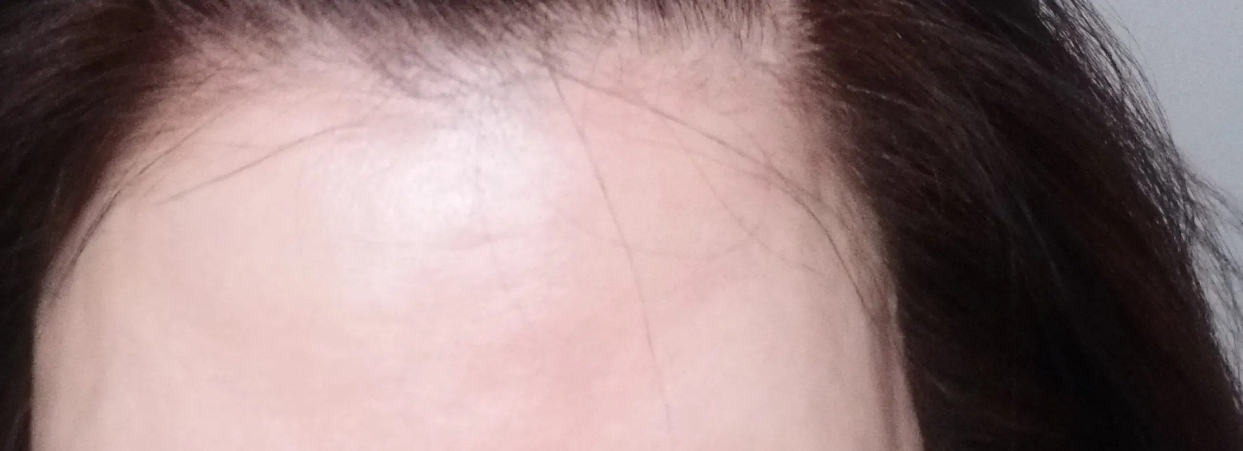 After treatment — Ribbon Youth Injection Rejuran Healer