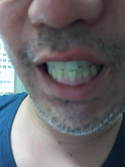After treatment — Teeth whitening, really! ♥ 39,000 won ♥