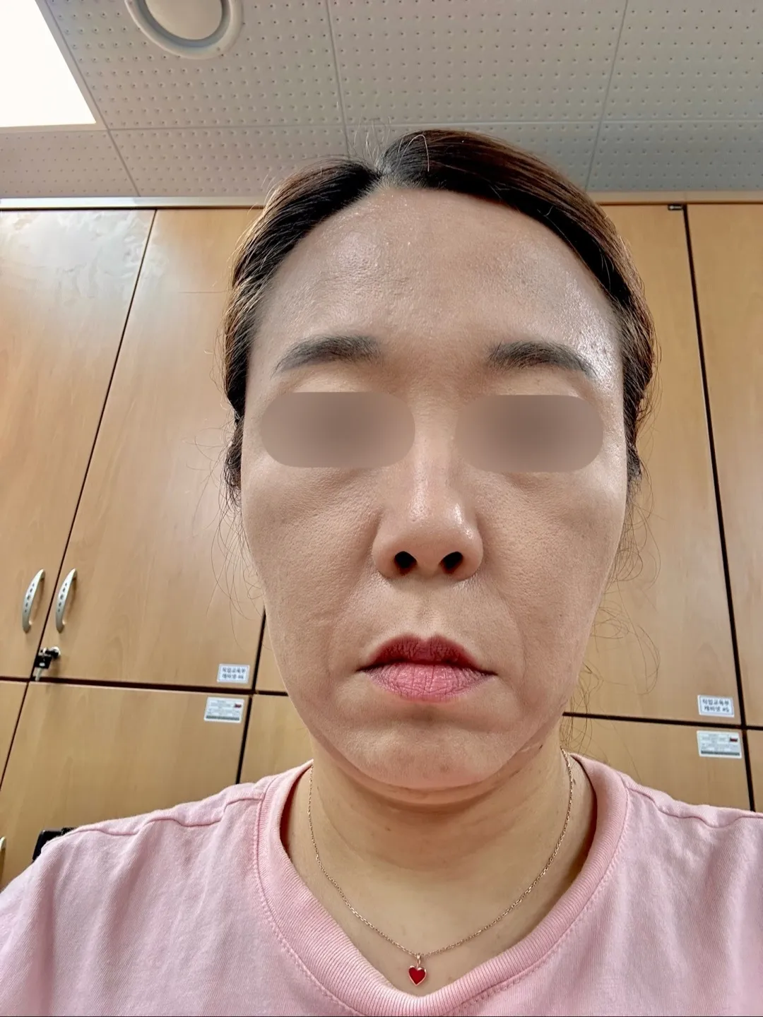시술 전 — 어려지는 동안 실리프팅