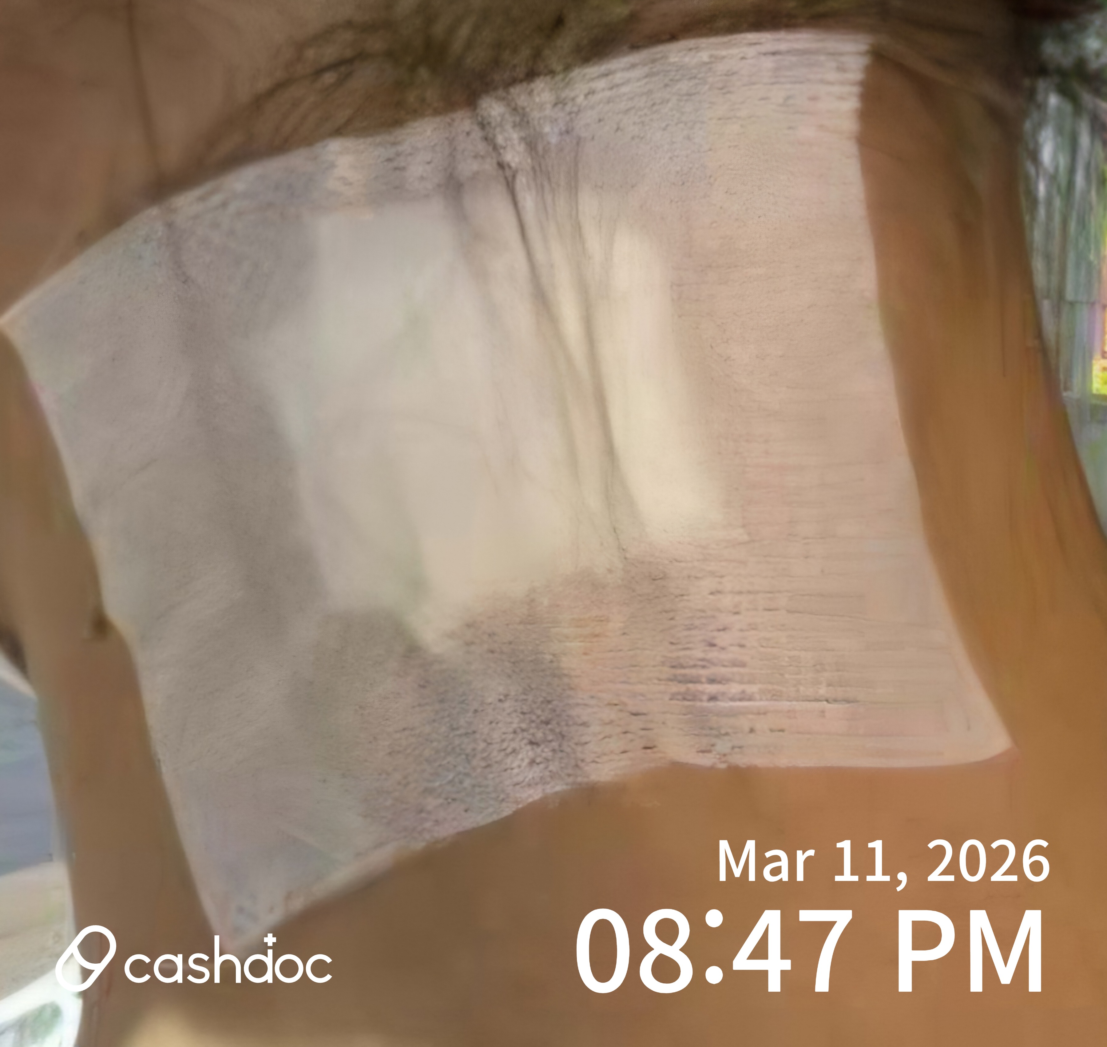 서구 삼성플러스유외과의원, 낭종 제거 수술 만족스러워요