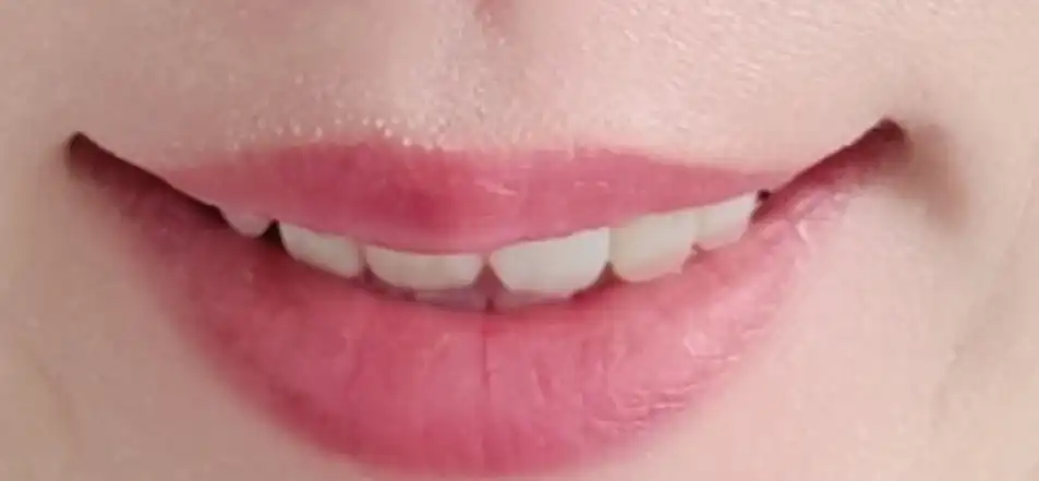 후