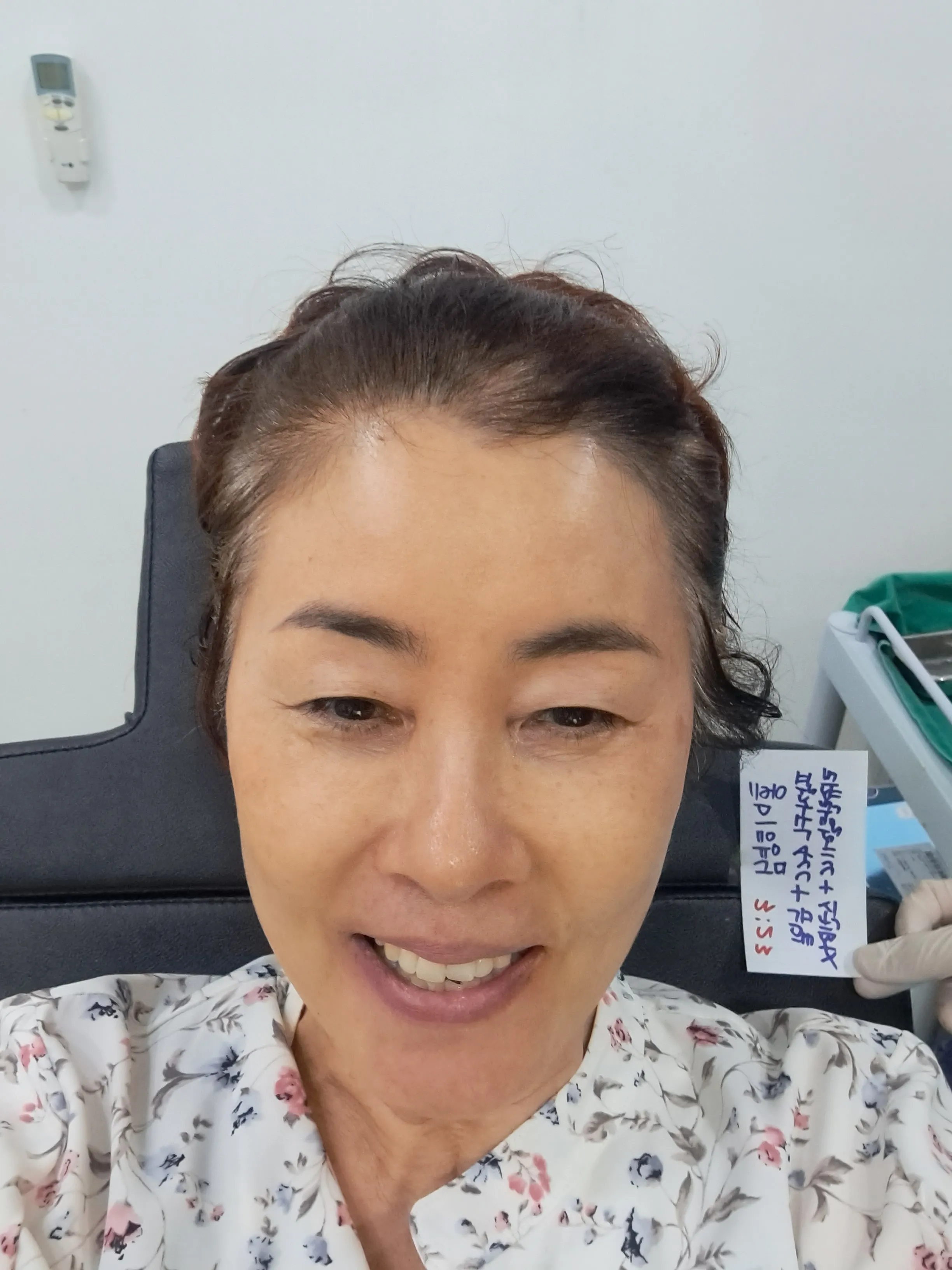 시술 전 — 팔자필러 1cc 3.8만원