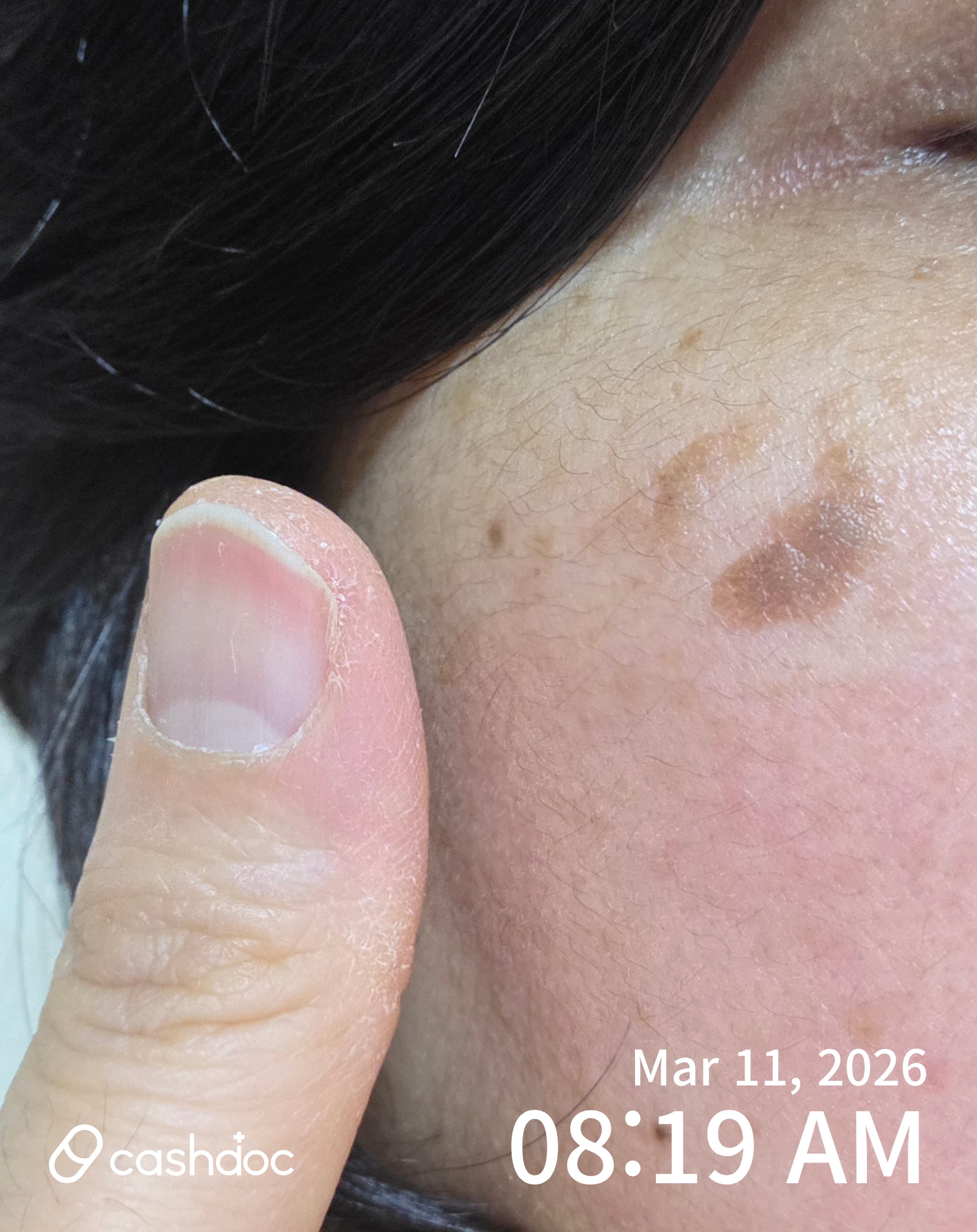 서초구 장덕한방병원에서 검버섯 치료 후기, 매우 만족해요!