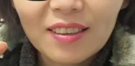 시술 전 — 미케이 주름&사각턱 보톡스