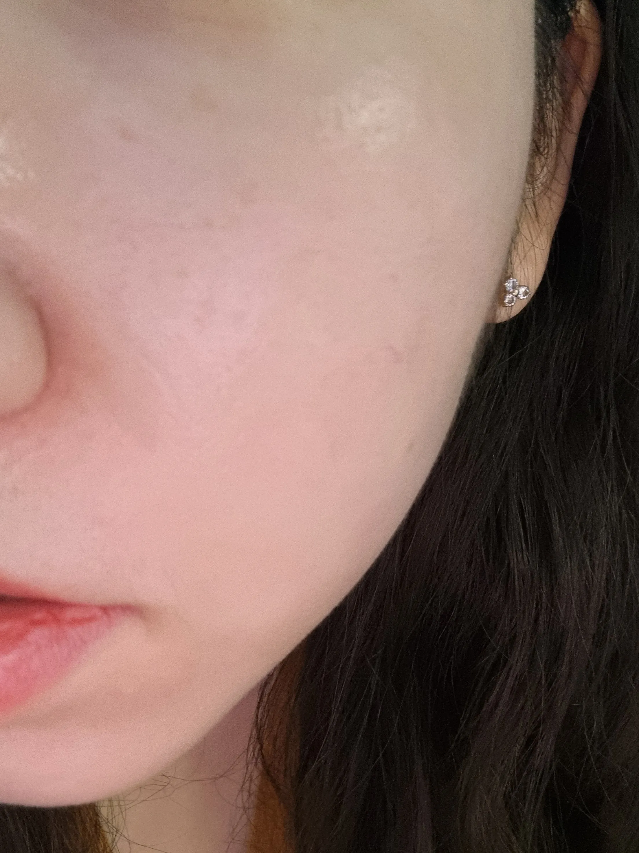 시술 전 — 인모드 리프팅