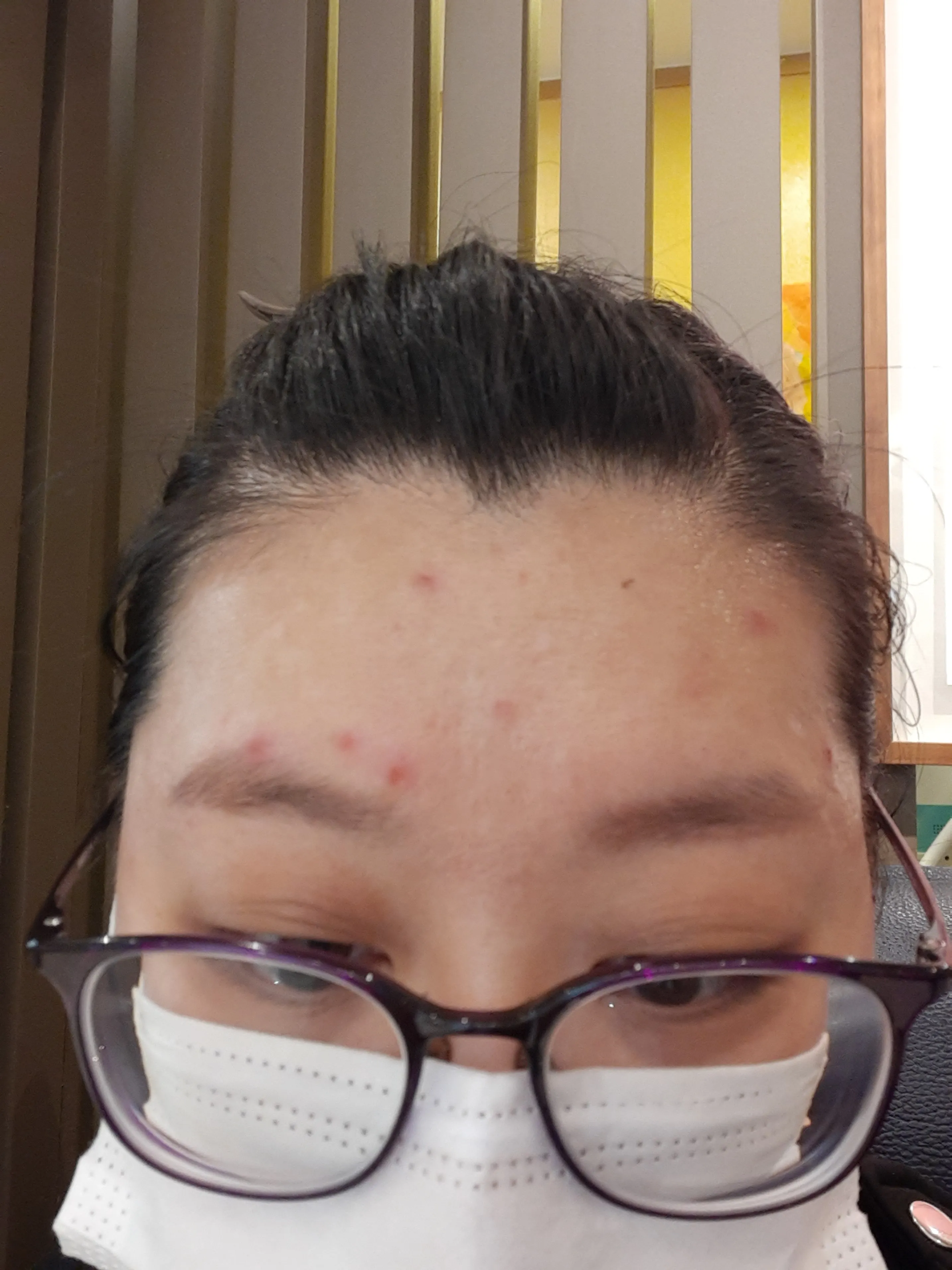 시술 전 — 눈썹문신제거 