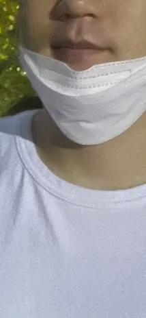 施術前 — クラリティアイスレーザー脱毛