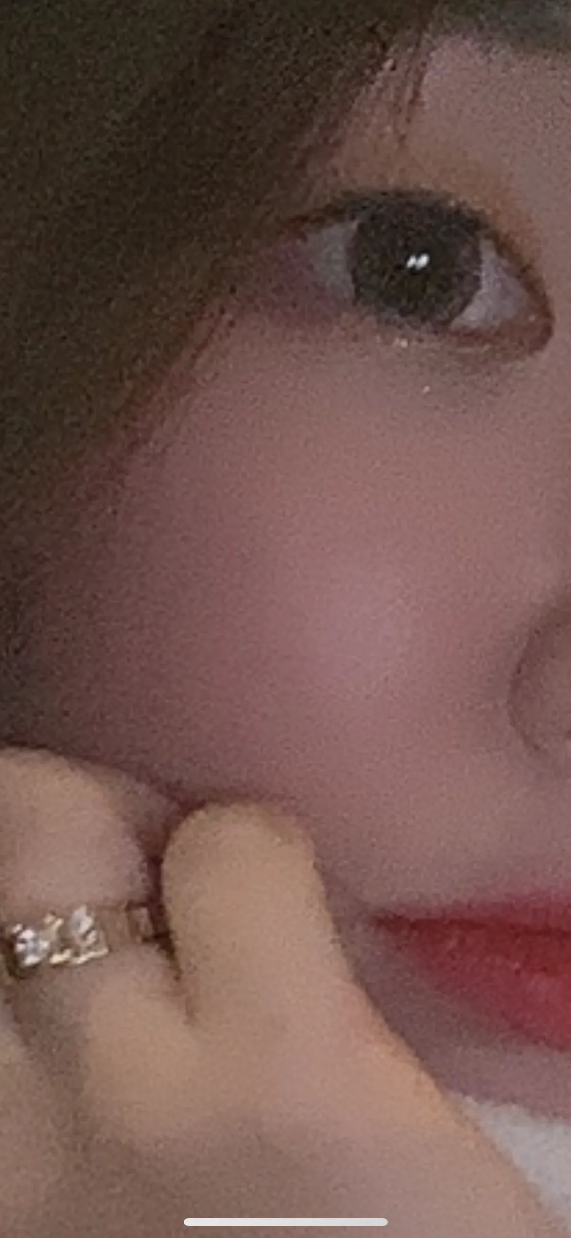 시술 전 — 아쿠아필/마스크트러블 집중관리