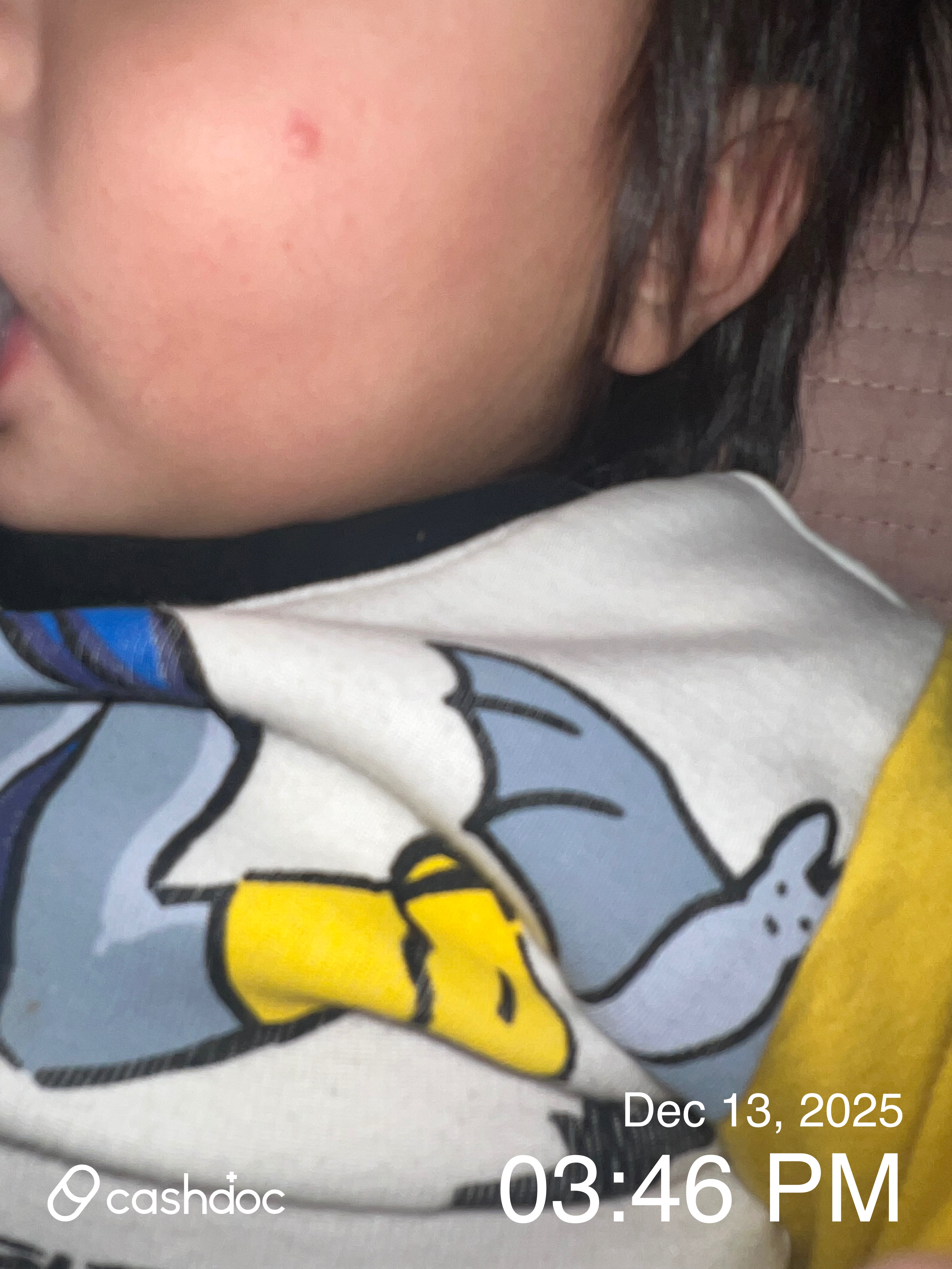 영종센트럴피부과, 아기 혹 진료 후 마음 놓였어요!