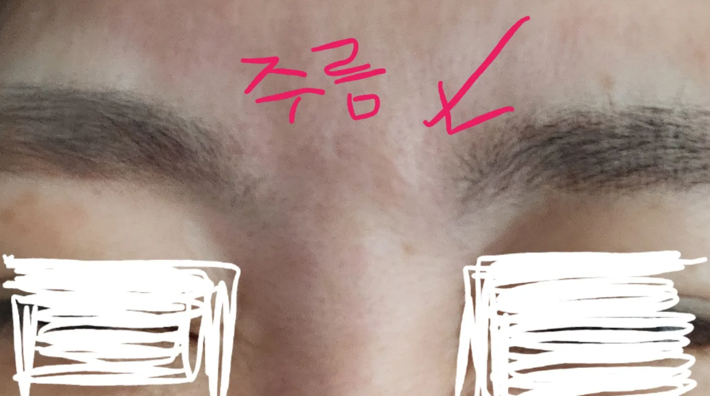 시술 전 — 창원) 인기 보톡스 시술 모음