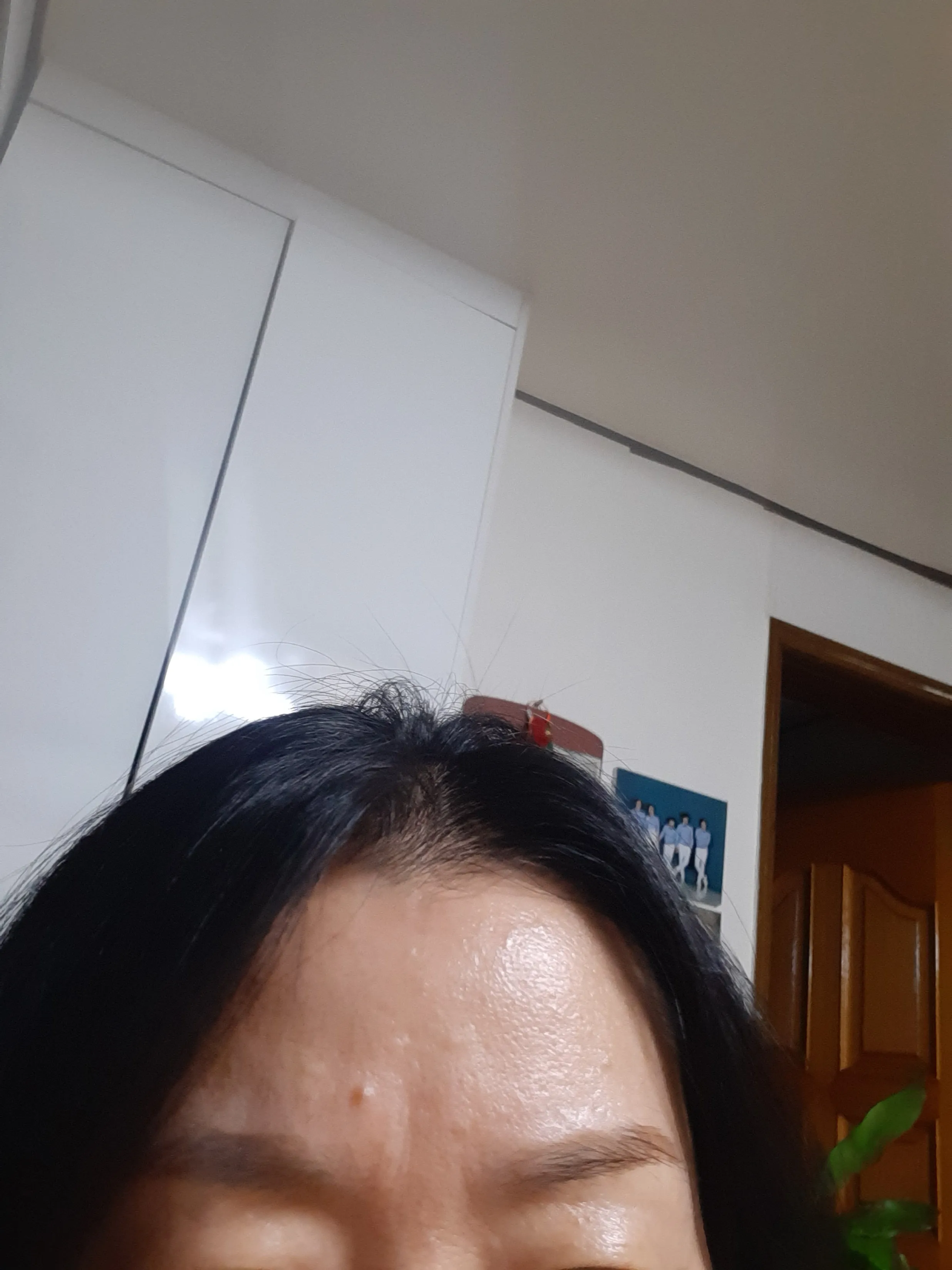 시술 전 — 첫방문 압구정비앤미  주름보톡스 