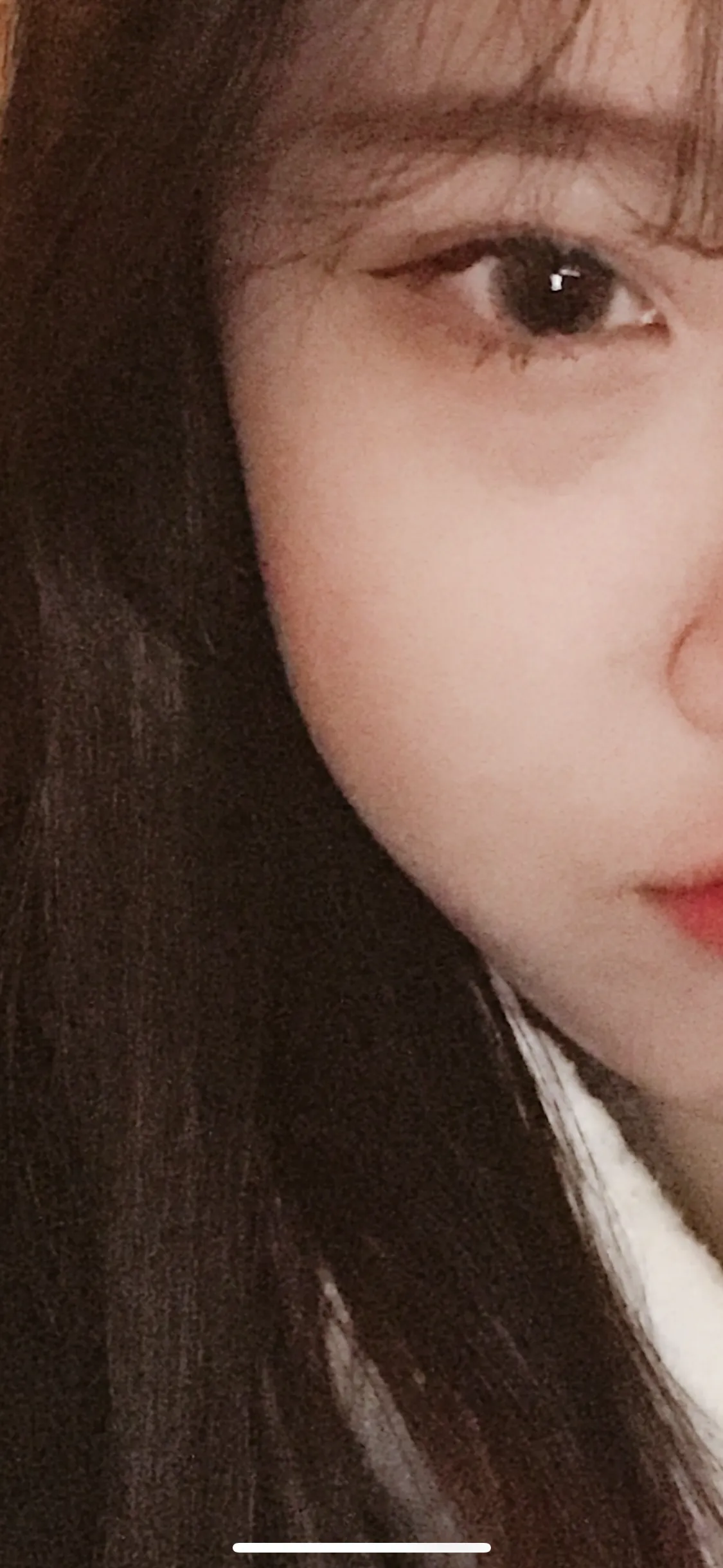 시술 전 — 고강도 초음파 슈링크 리프팅