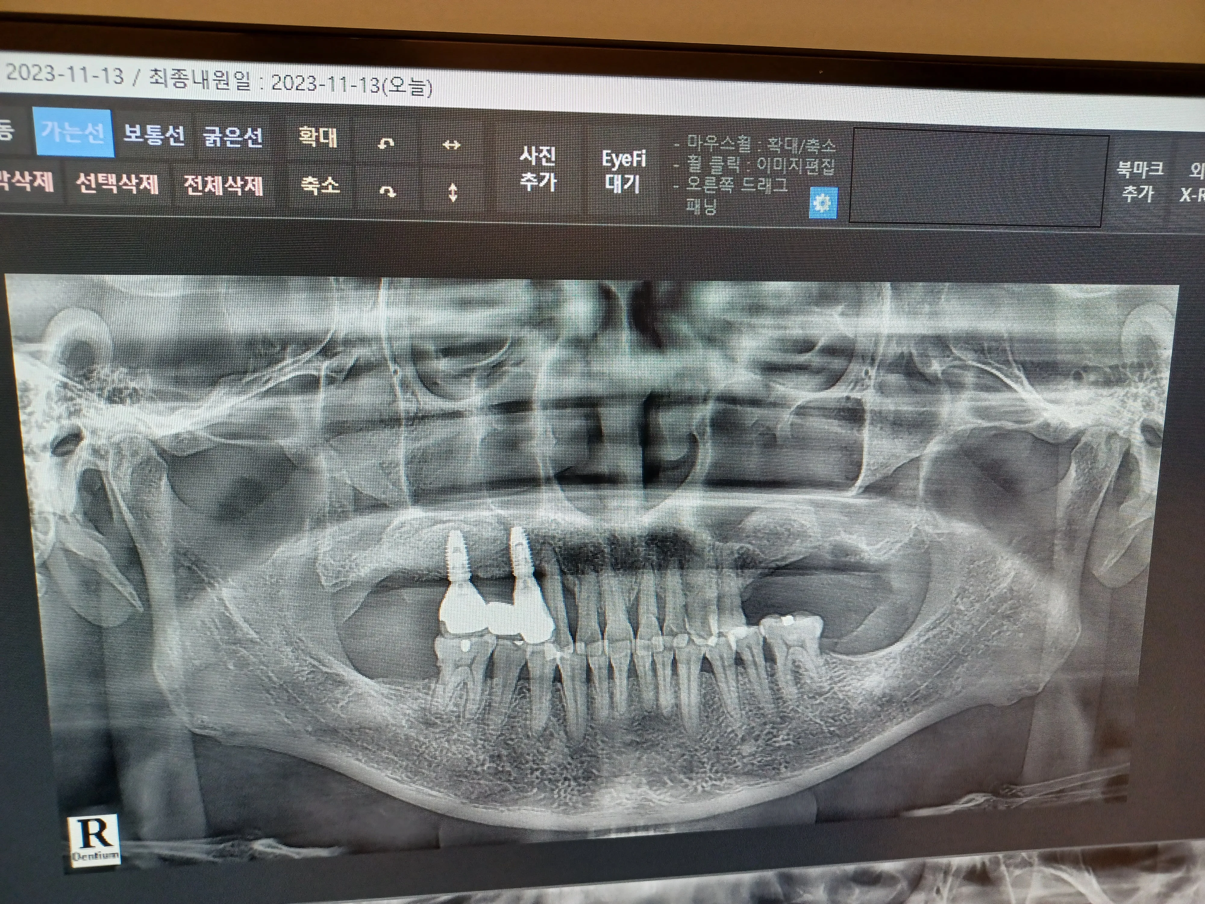 项目后 — 没有额外费用的30万韩元种植牙