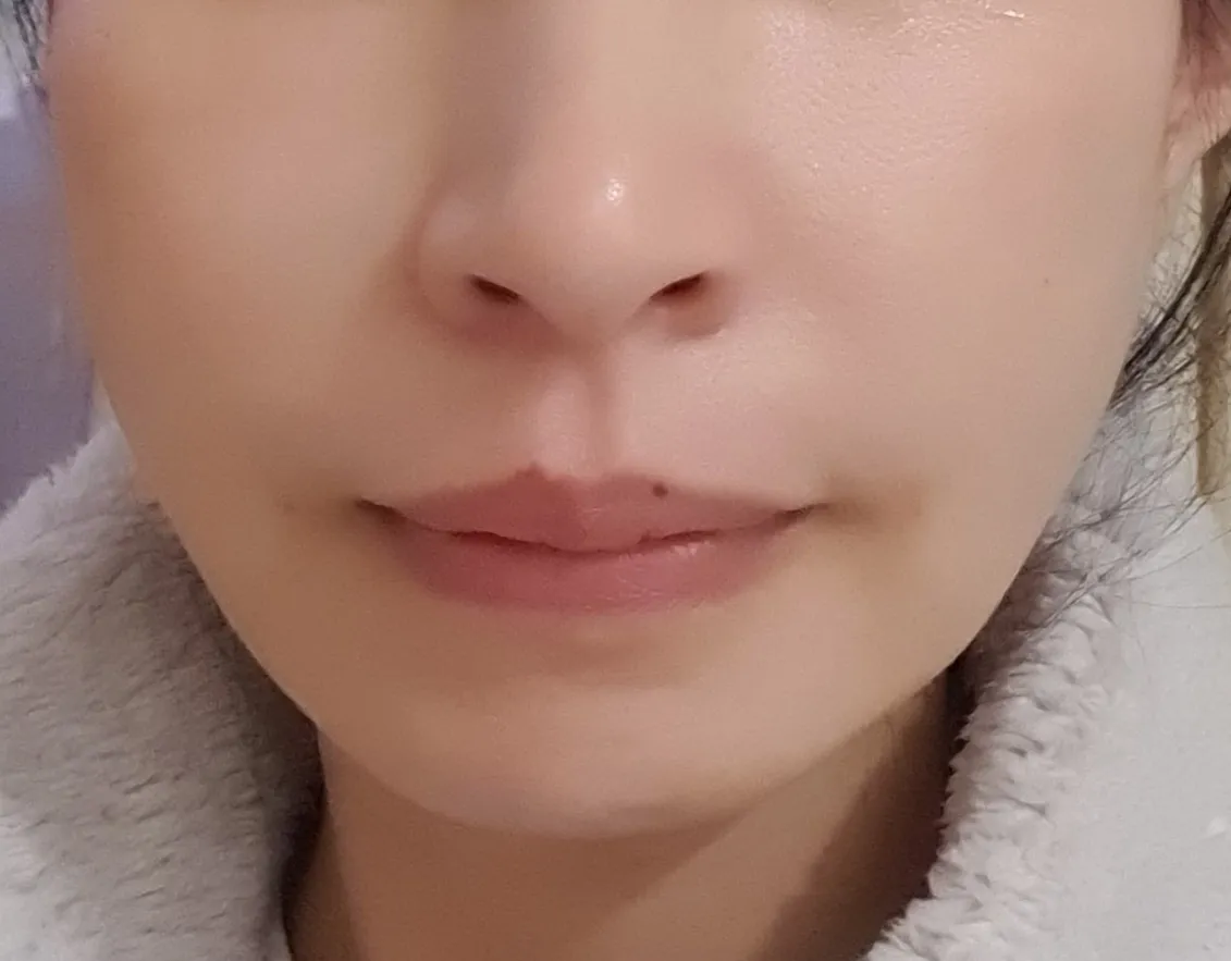 시술 후 — 실리프팅+필러 💙꿈프팅💙 29만원