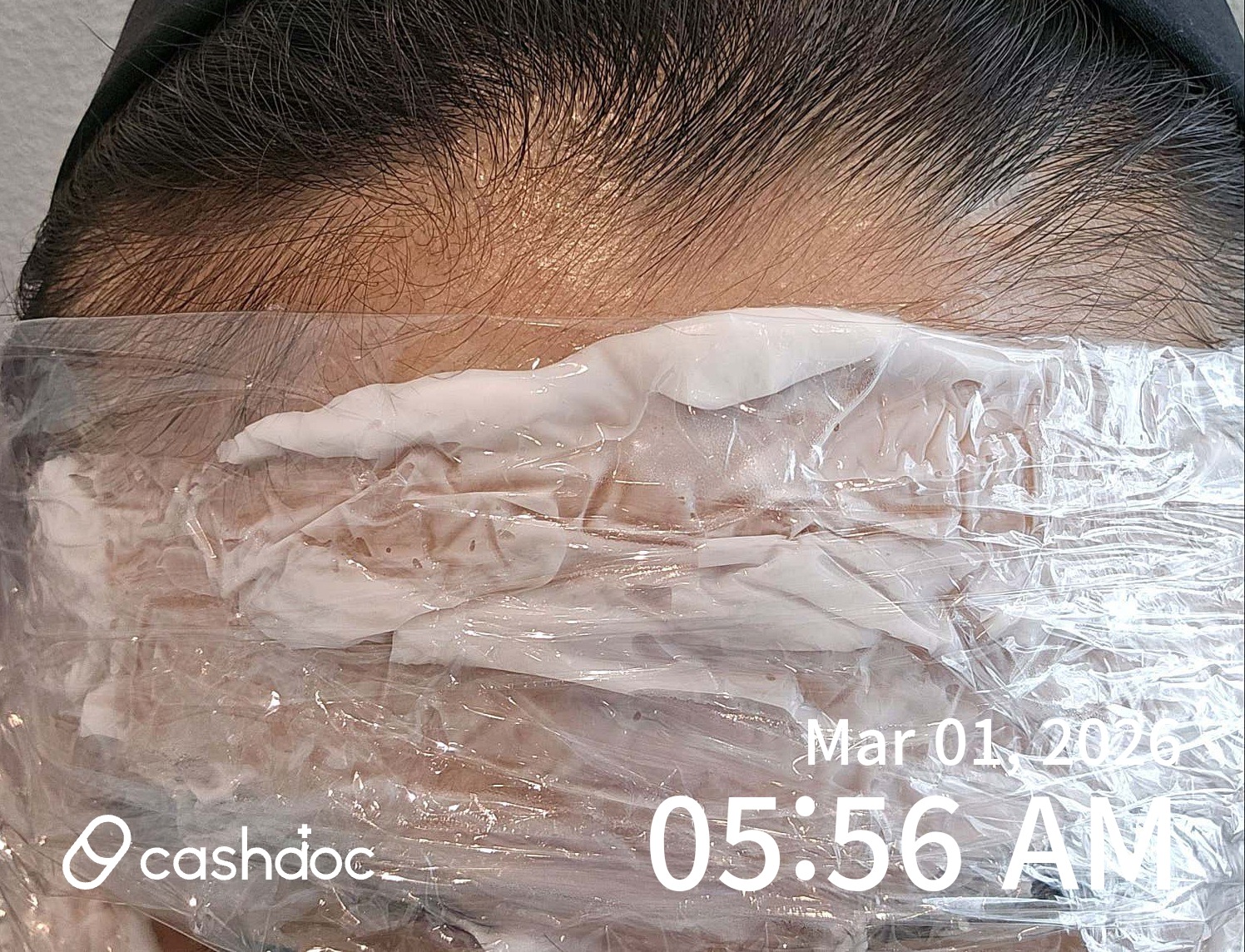 강릉시 아름다운피부과의원에서 만족한 이마 보톡스 경험