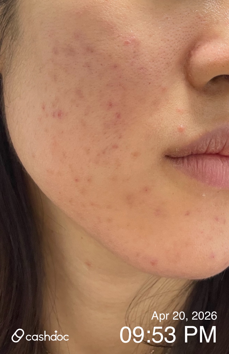 오랫동안 반복되는 여드름 때문에 스트레스가 정말 컸는데, 이번에 피부과 치료를 받으면서 눈에 띄게 좋아진 피부를 보면 진작 올 걸 그랬다는 생각뿐입니다. 혼자서 압출하거나 화장품으로 해결하려 할 때는 흉터만 남고 상황이 악화되기 일쑤였는데, 전문가의 체계적인 관리를 받으니 확실히 다르네요.