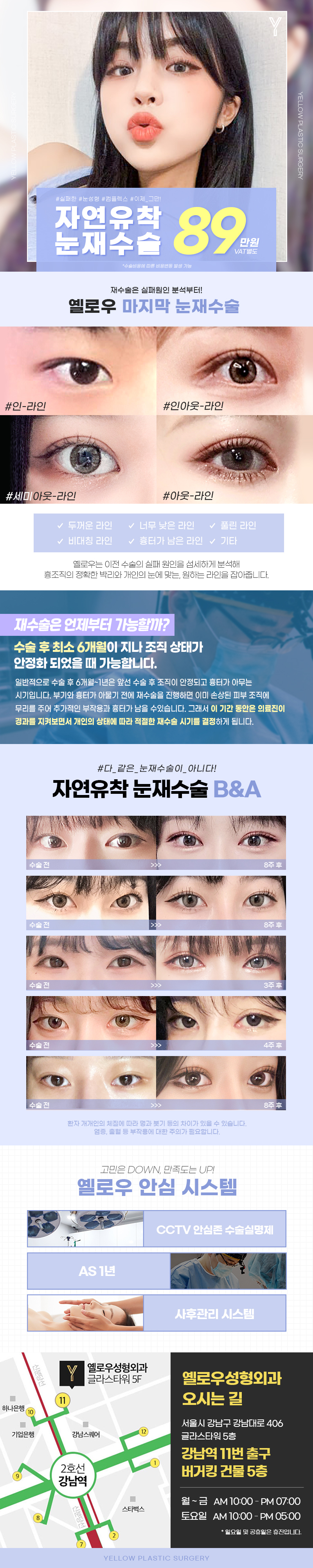 옐로우성형외과 💛옐로우 눈재수술💛 이벤트, 시술 상세 이미지