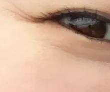 Before treatment — Lize Eye (Rejuran Eye + Eye Shrink) Package