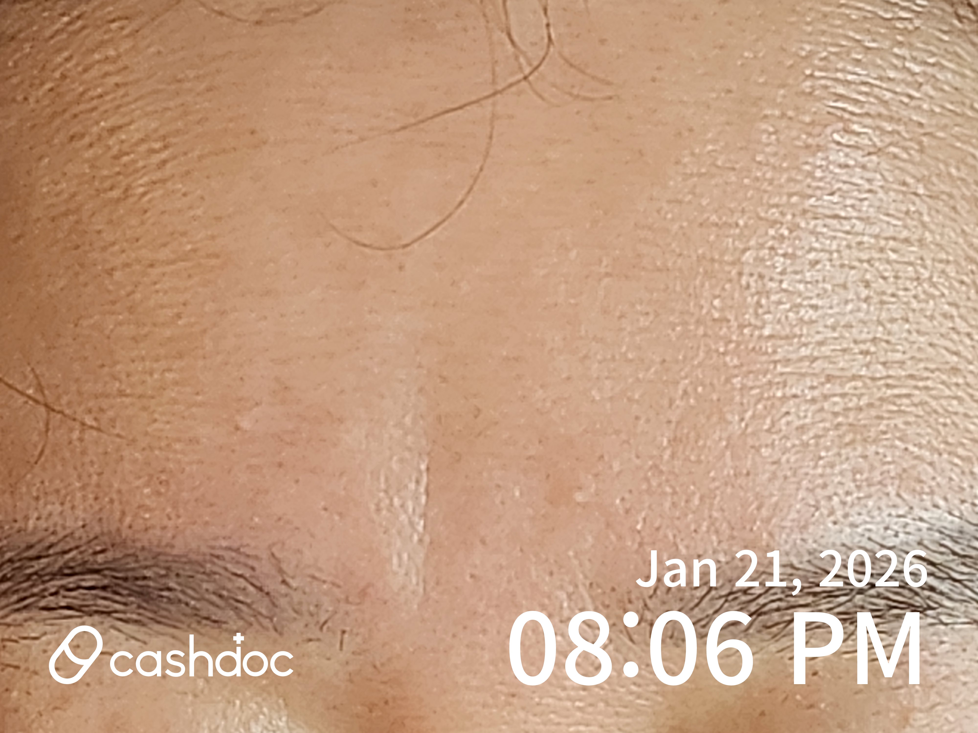 블리비의원 하남미사점, 기다림 가치 있는 미간 보톡스 경험