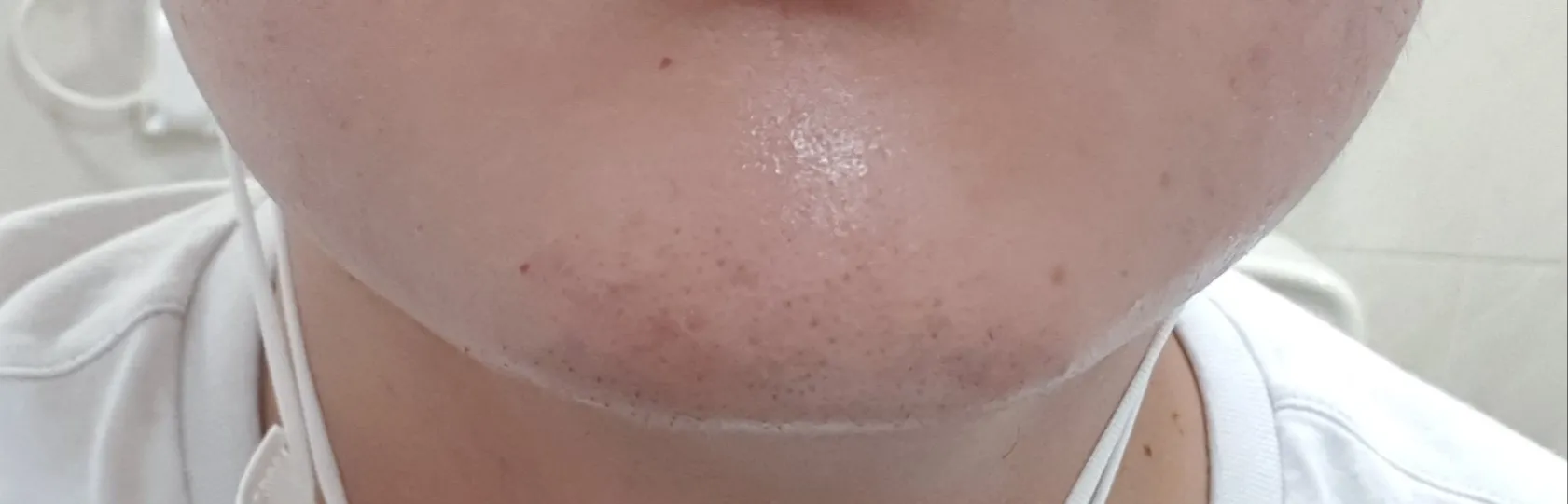 施術前 — 男性用RAZR脱毛