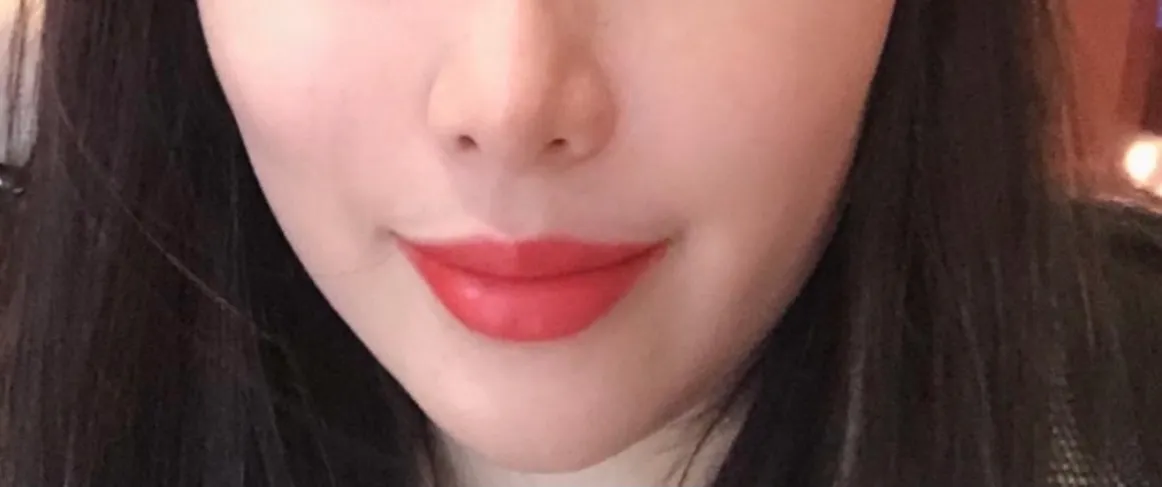 시술 전 — 🧡하뚜입술필러