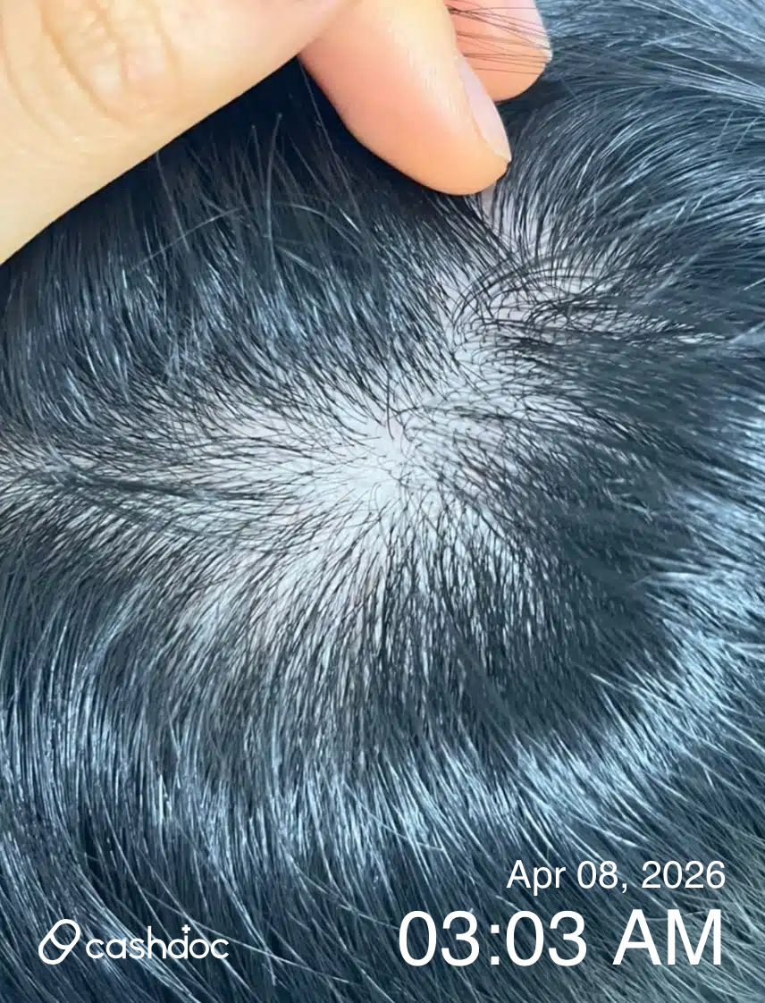 종로구 맥스웰피부과에서 원형탈모 치료 만족해요