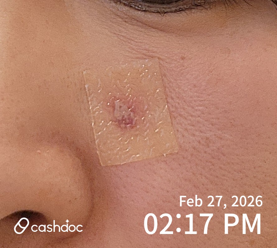 중랑구 숲피부과의원에서 피지 제거 경험 후기