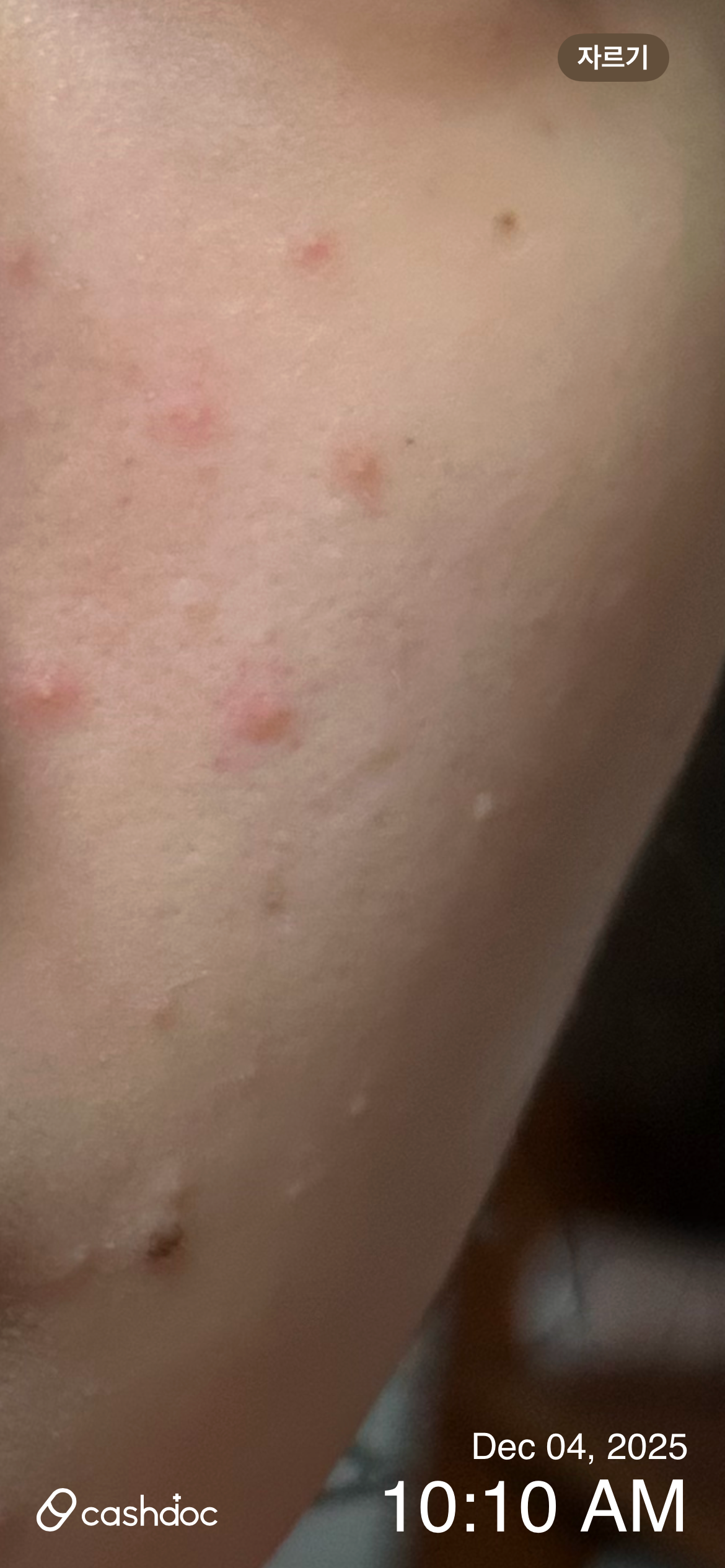 매직피부과의원에서 급한 피부 가려움증과 여드름, 친절한 진료에 감사해요!